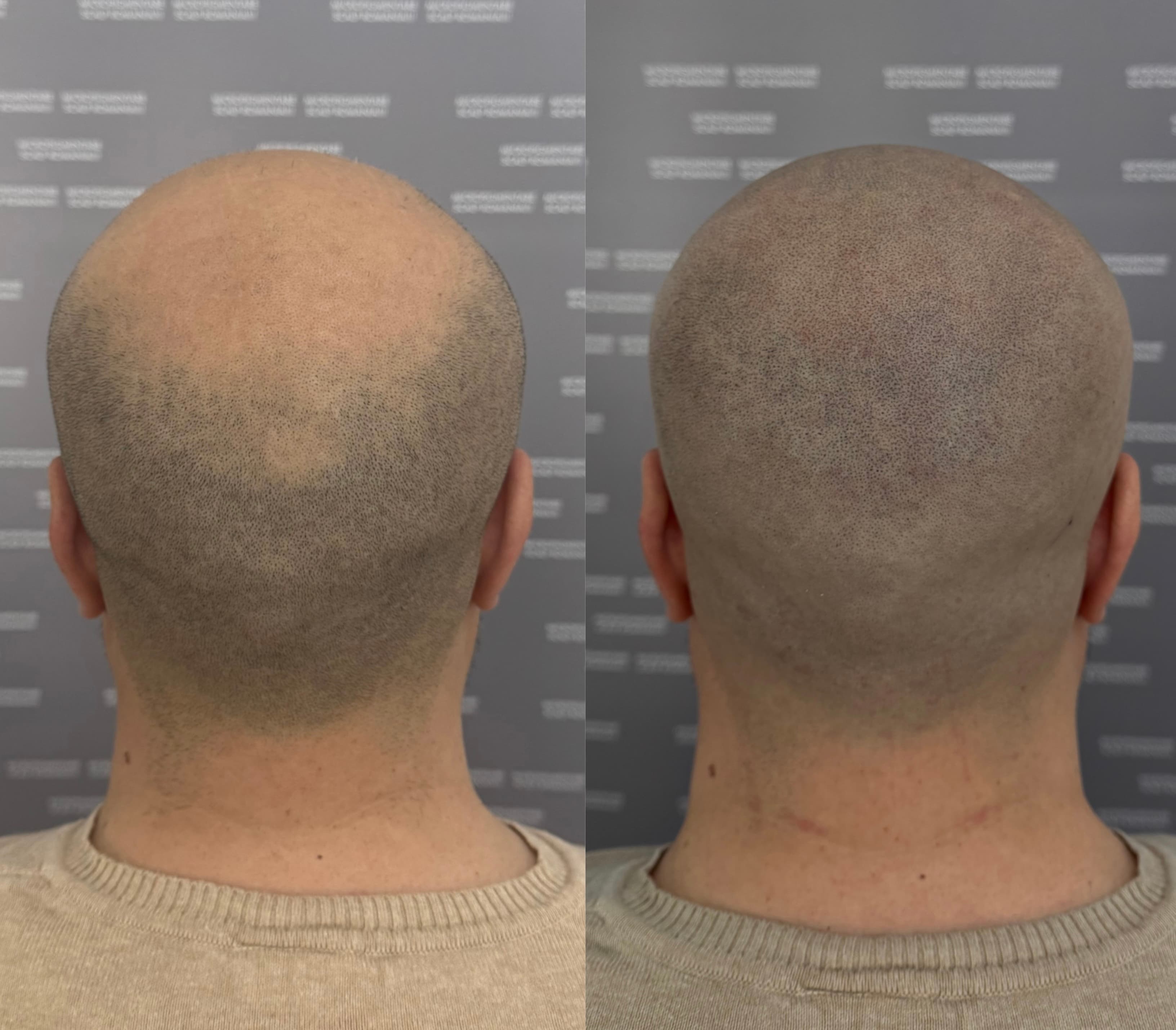 Perspectivă micropigmentare scalp - Alopecie Androgenetică