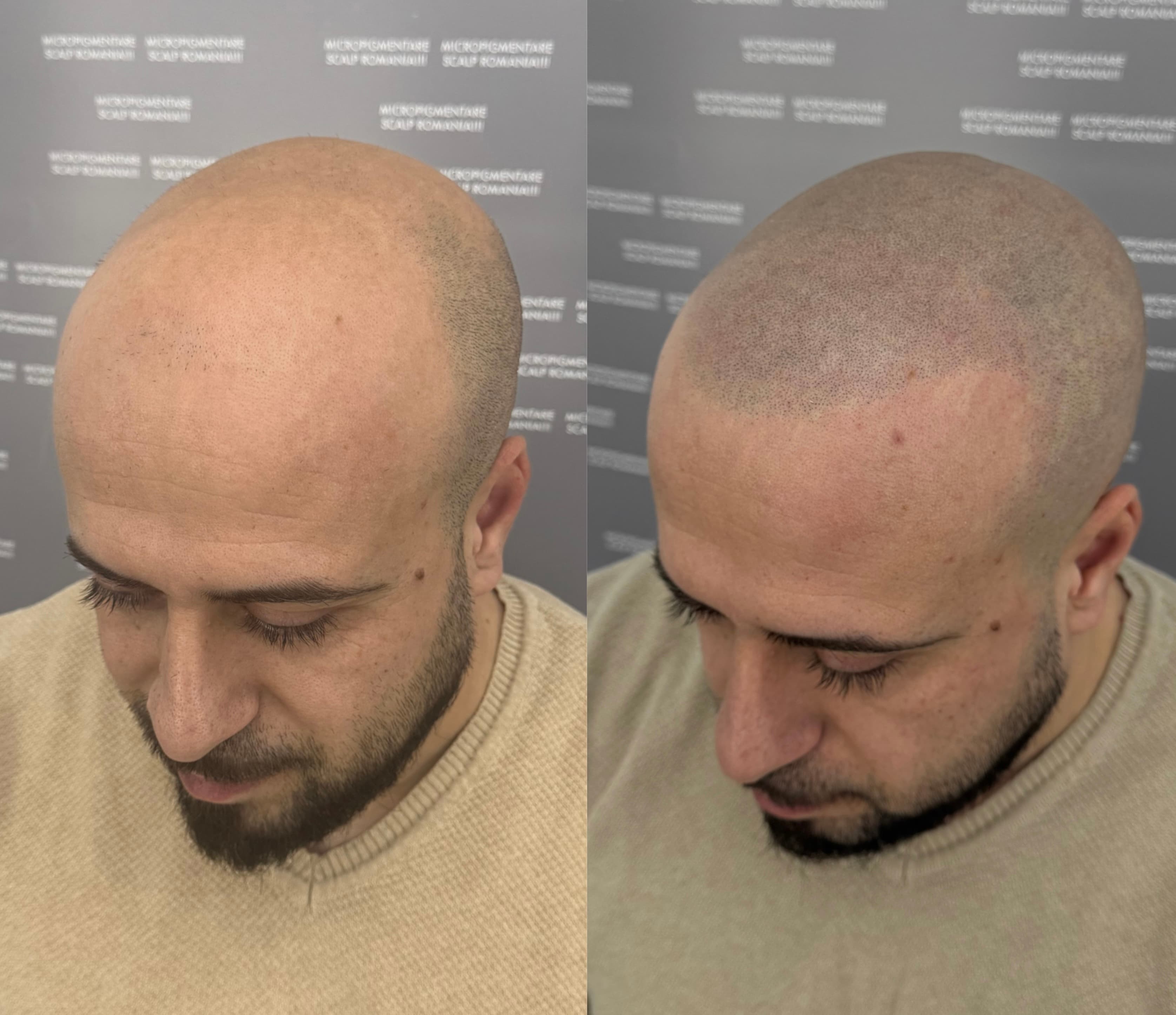 Perspectivă micropigmentare scalp - Alopecie Androgenetică