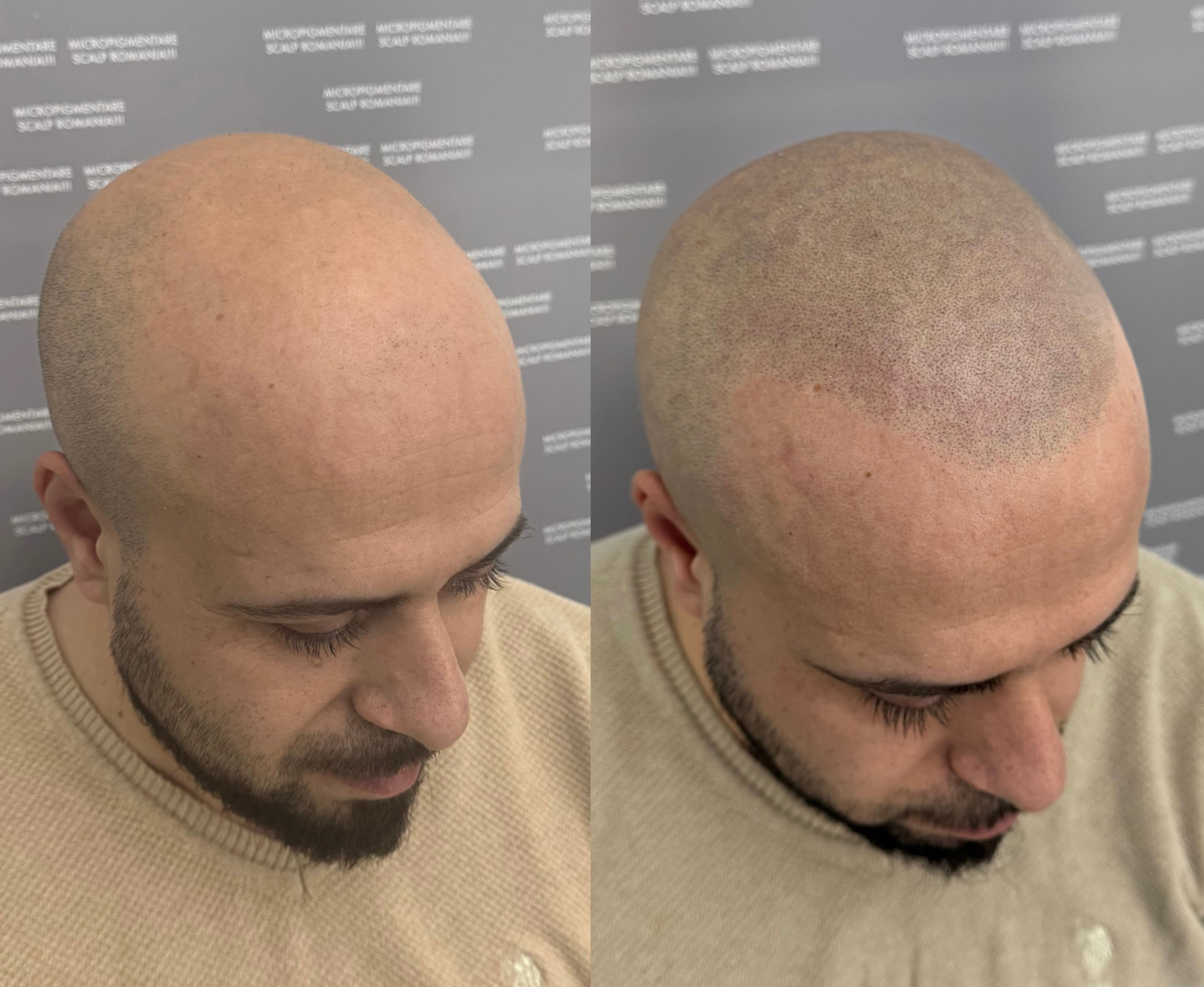 Perspectivă micropigmentare scalp - Alopecie Androgenetică