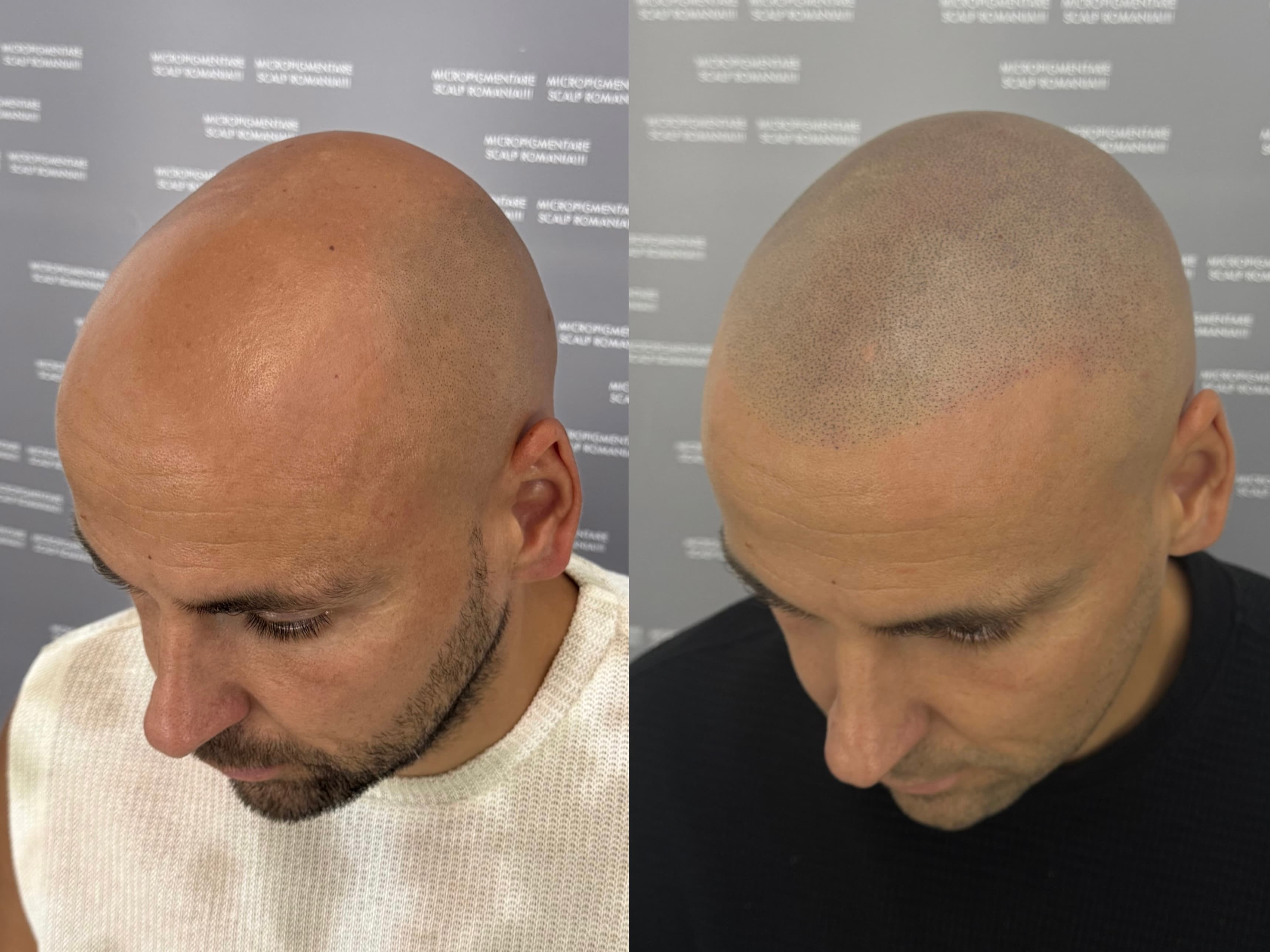 Perspectivă micropigmentare scalp - Alopecie Androgenetică