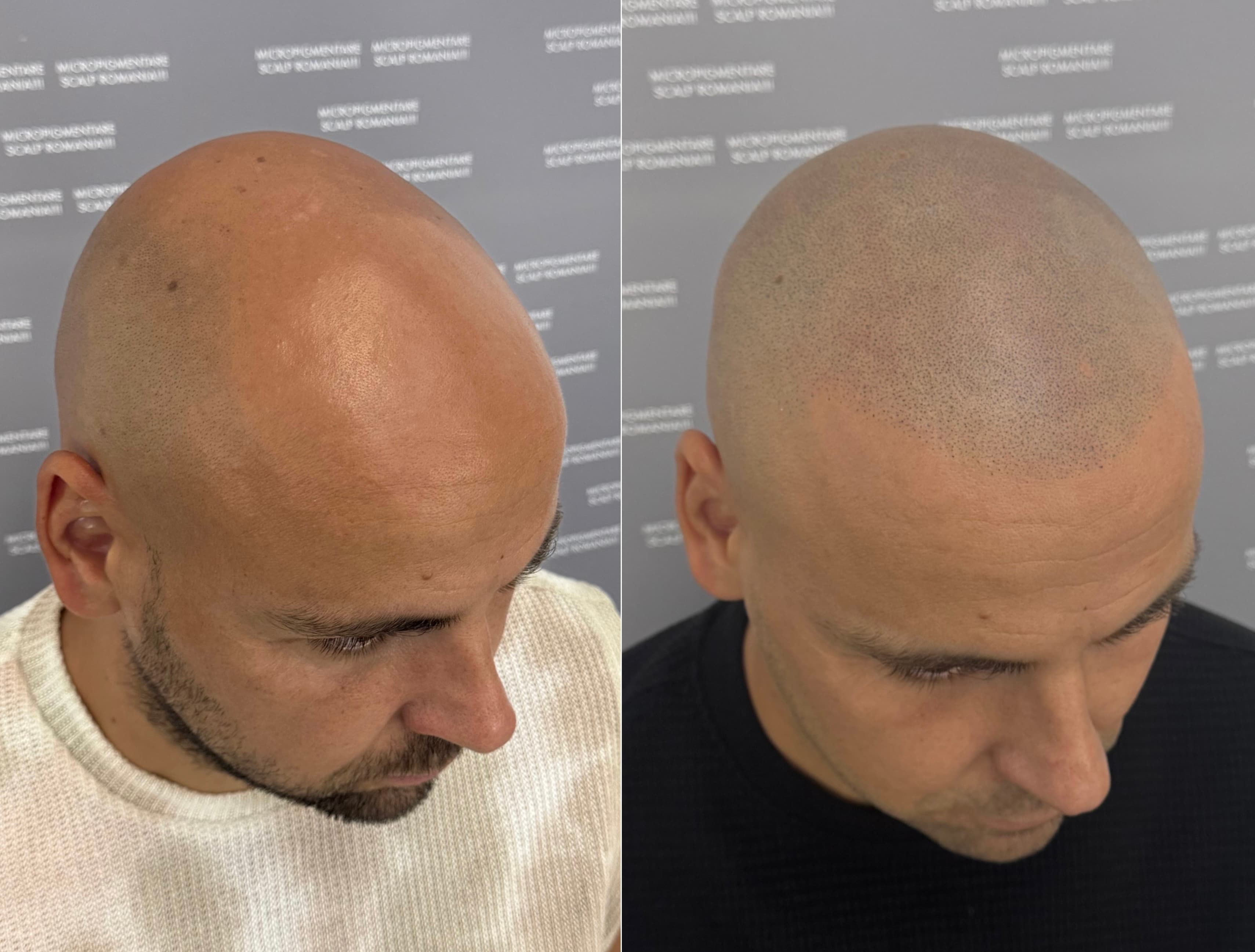 Perspectivă micropigmentare scalp - Alopecie Androgenetică