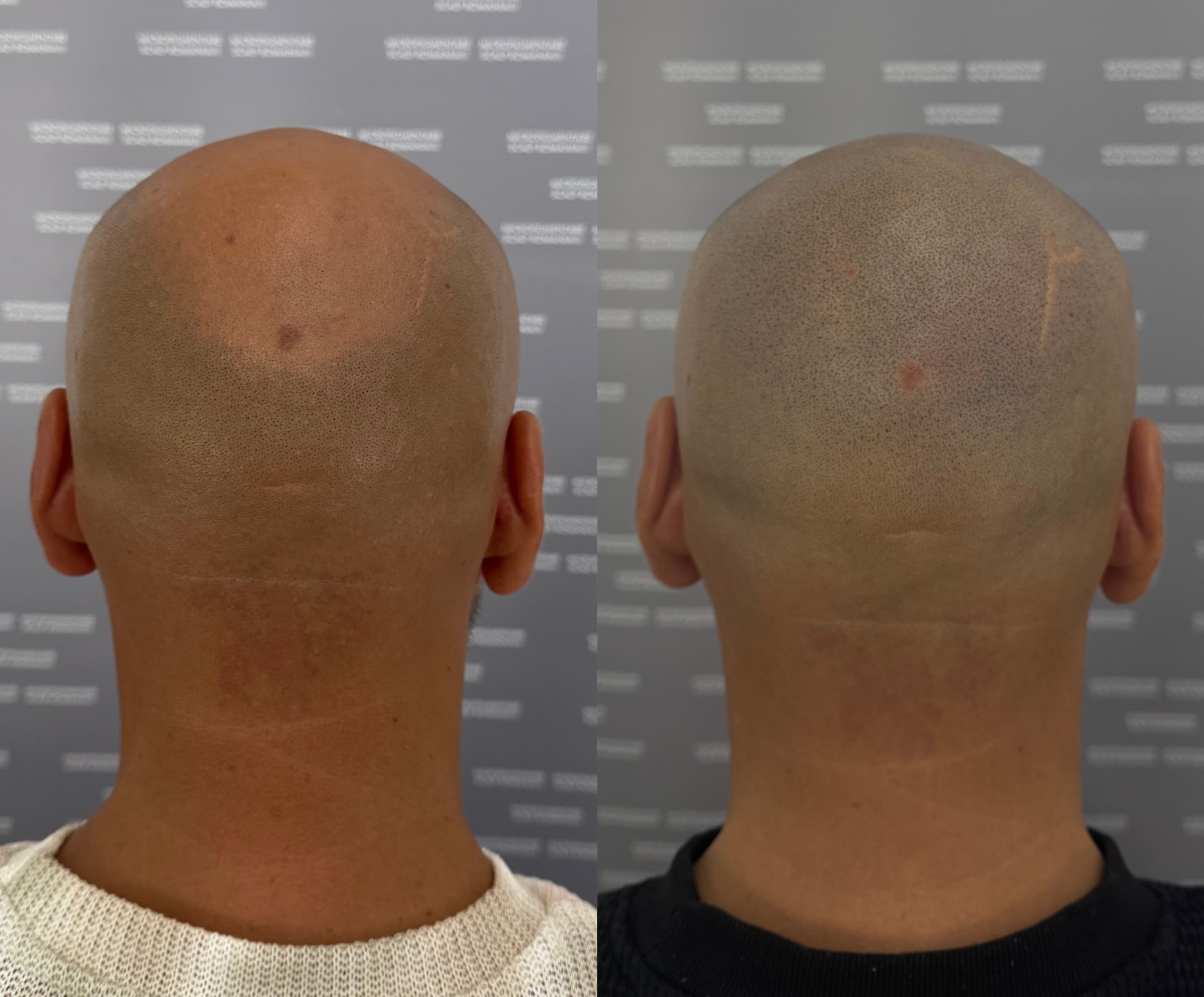 Perspectivă micropigmentare scalp - Alopecie Androgenetică