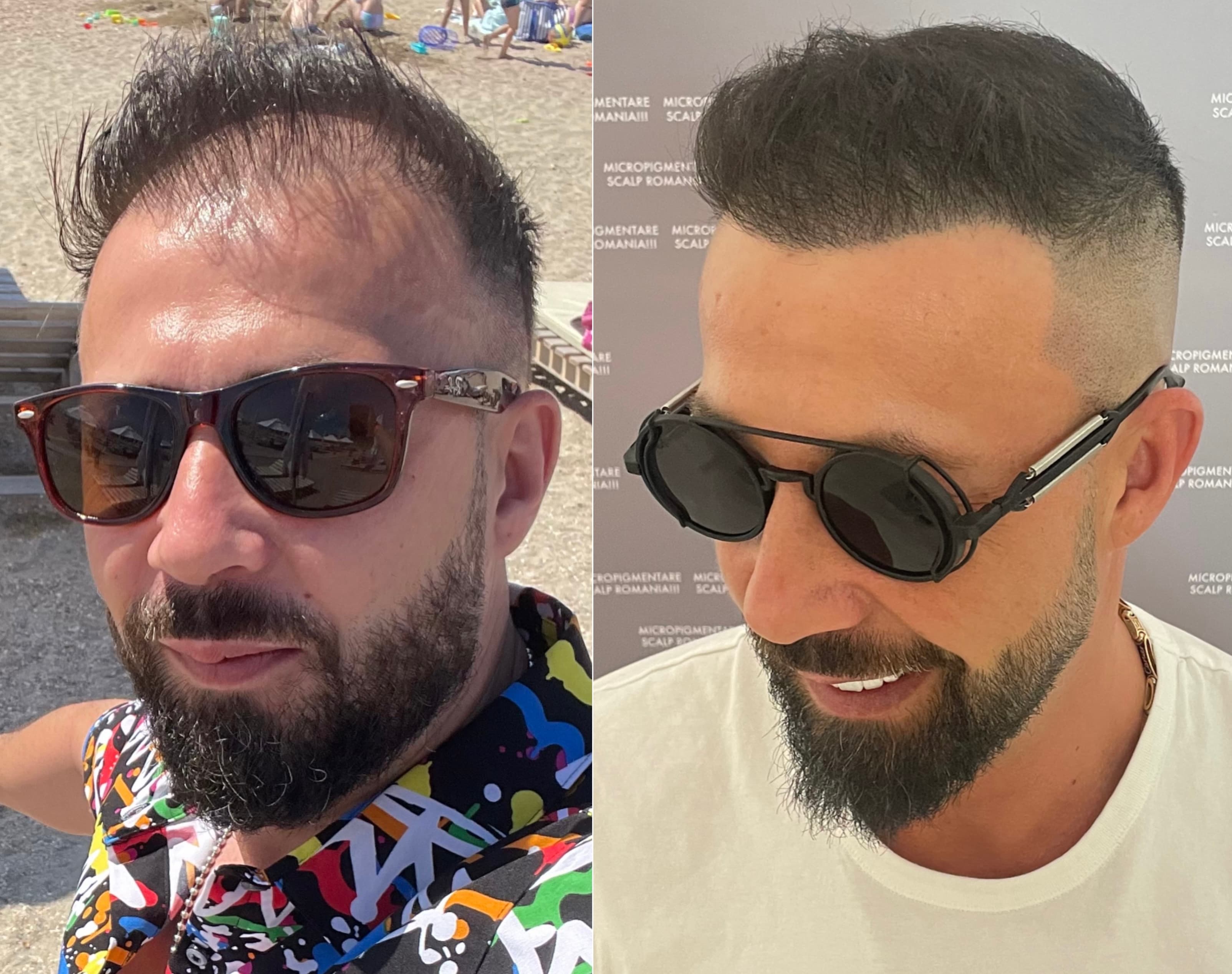 Perspectivă micropigmentare scalp - Densitate Post Transplant
