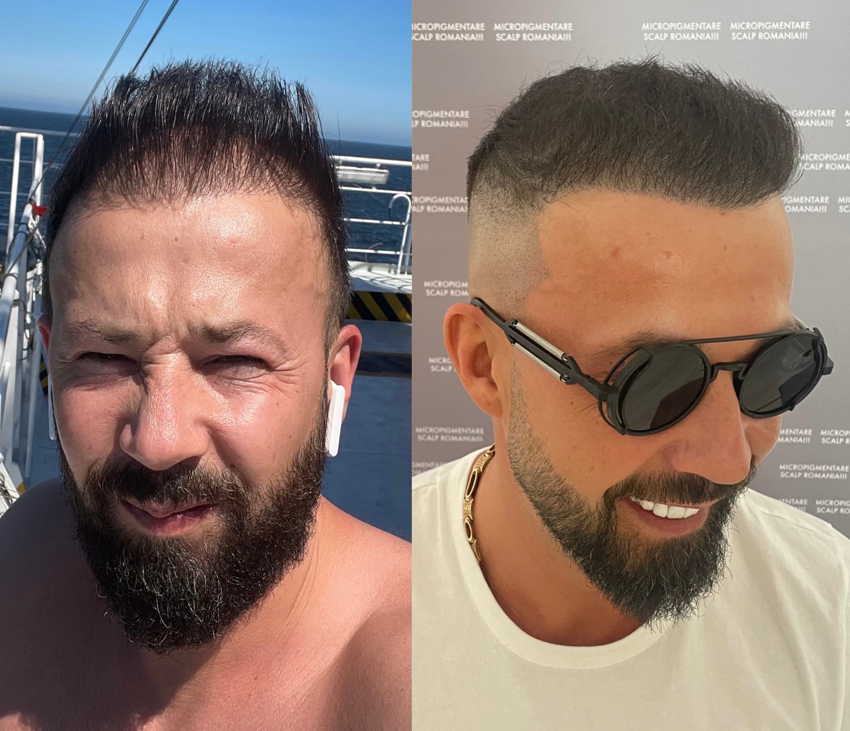 Perspectivă micropigmentare scalp - Densitate Post Transplant