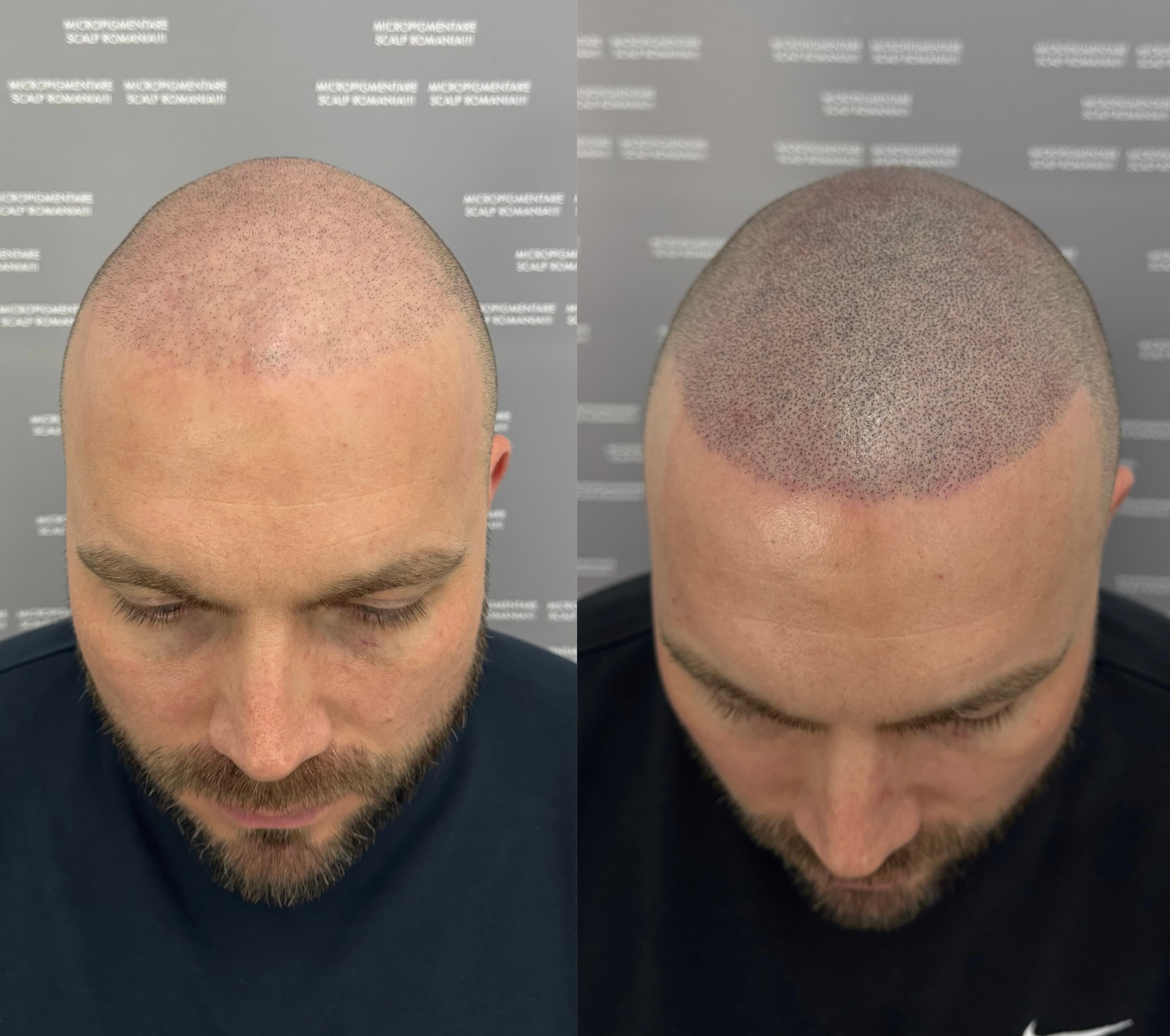Perspectivă micropigmentare scalp - Densitate Post Transplant