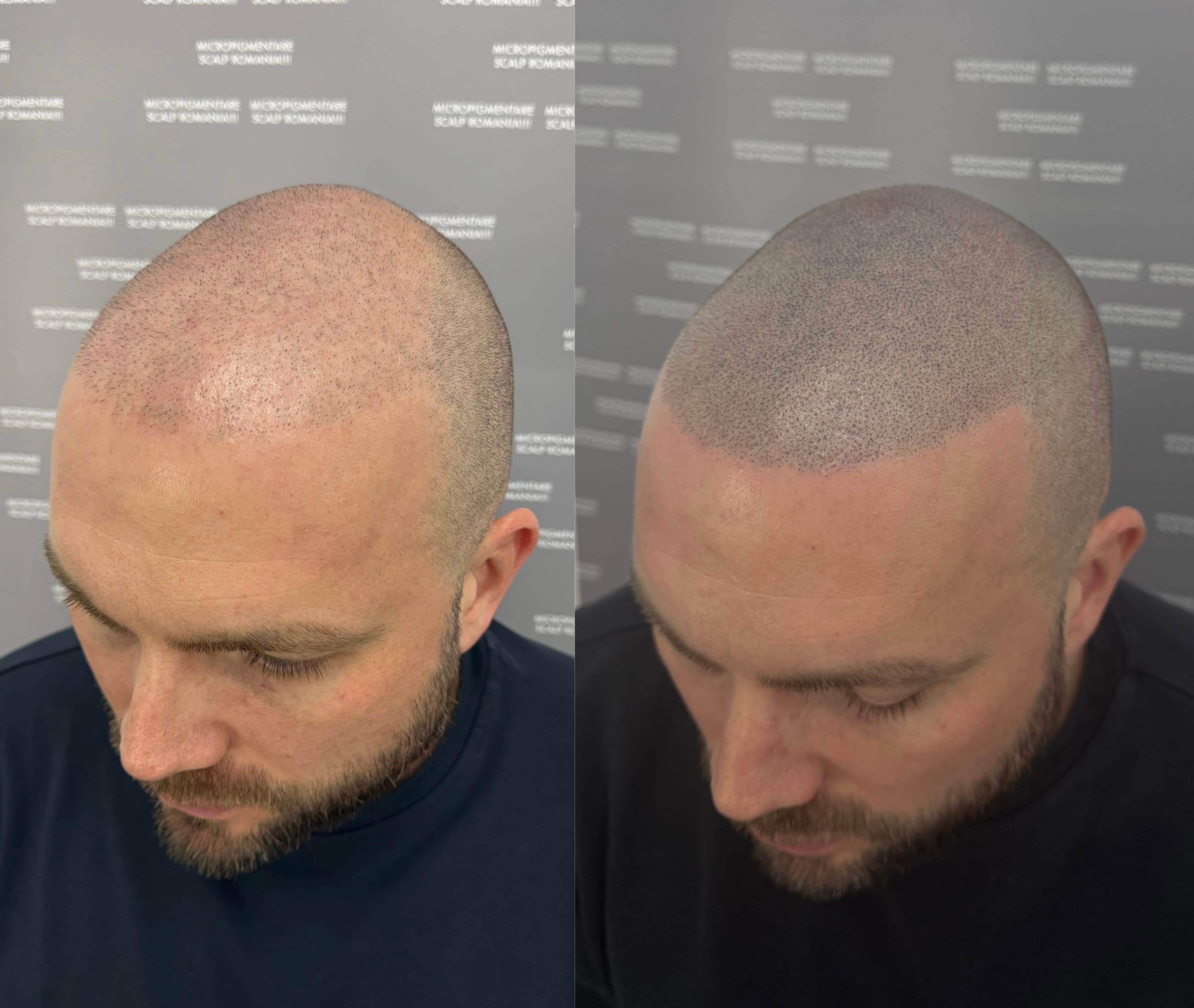Perspectivă micropigmentare scalp - Densitate Post Transplant