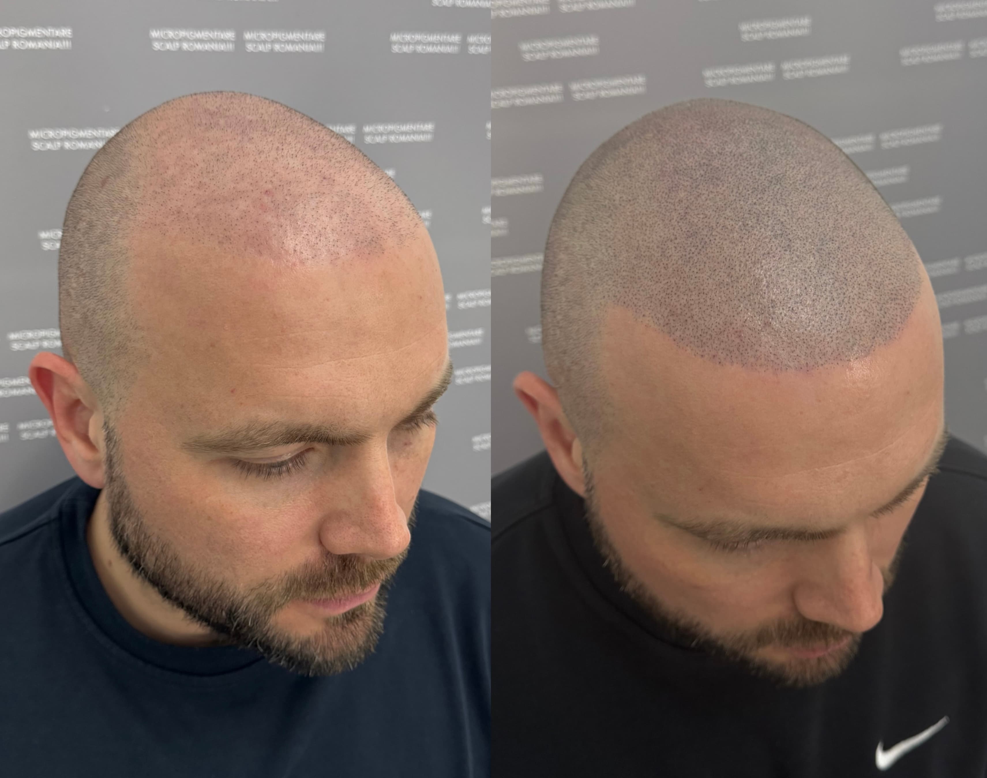 Perspectivă micropigmentare scalp - Densitate Post Transplant