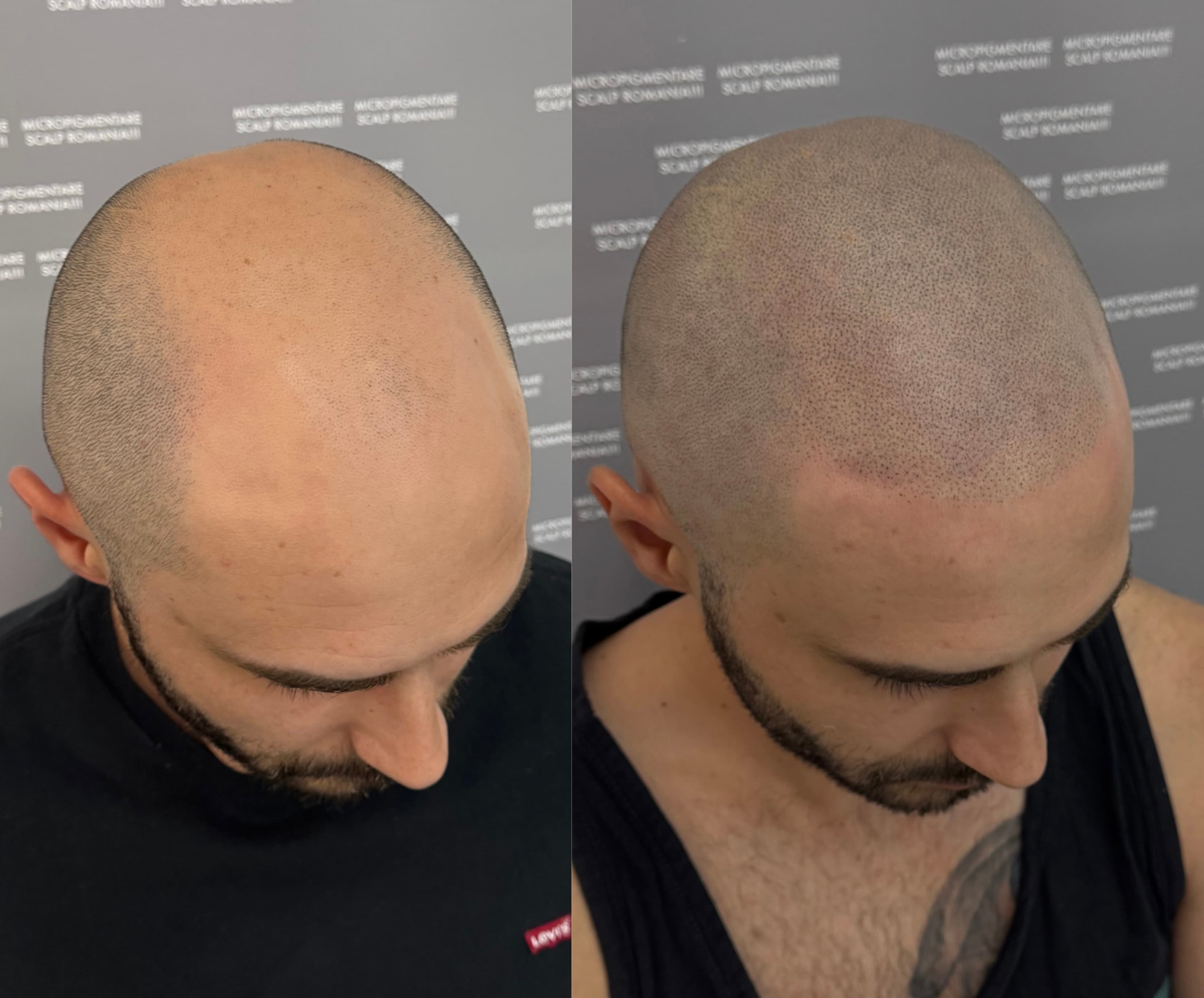 Perspectivă micropigmentare scalp - Alopecie Androgenetică