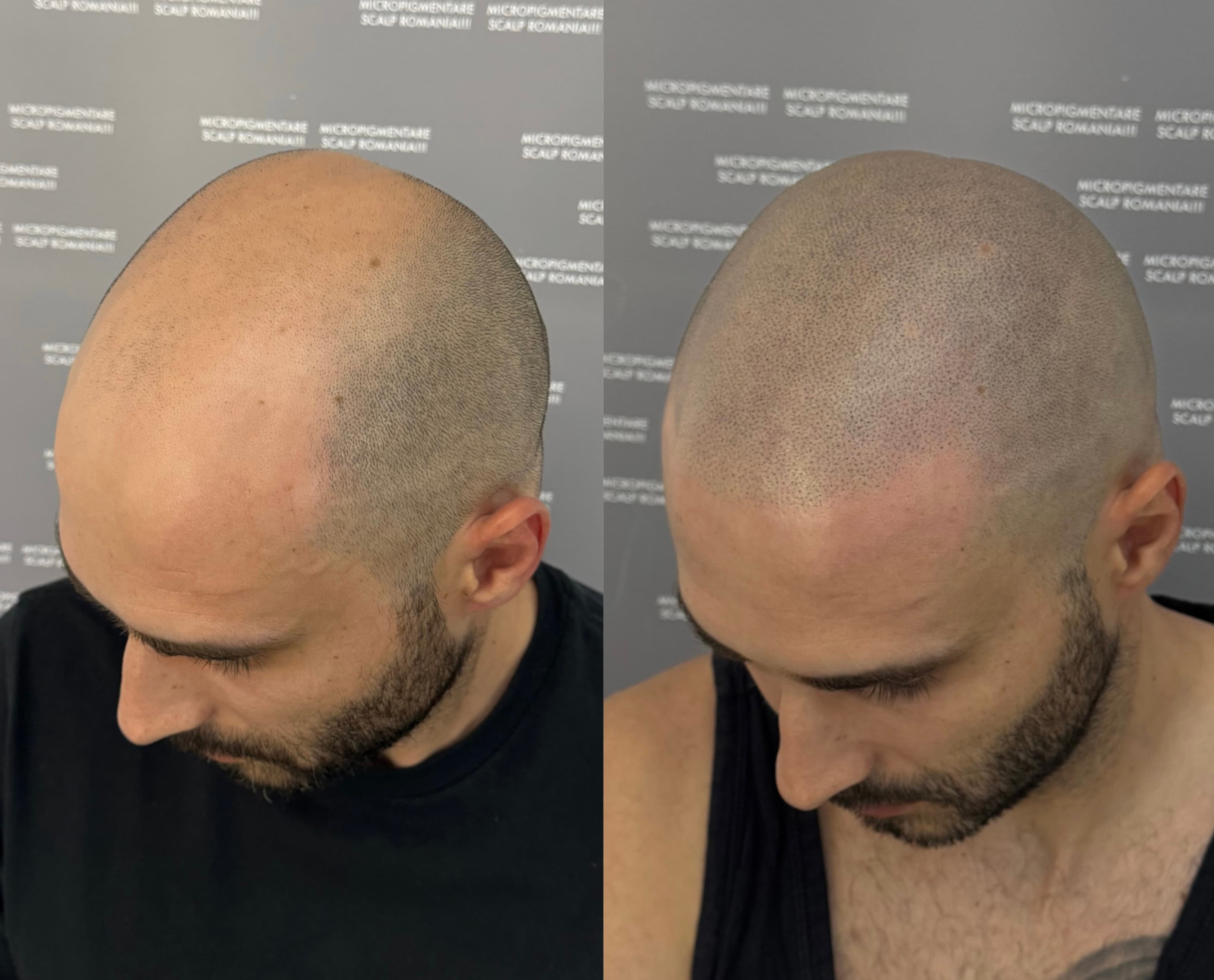 Perspectivă micropigmentare scalp - Alopecie Androgenetică