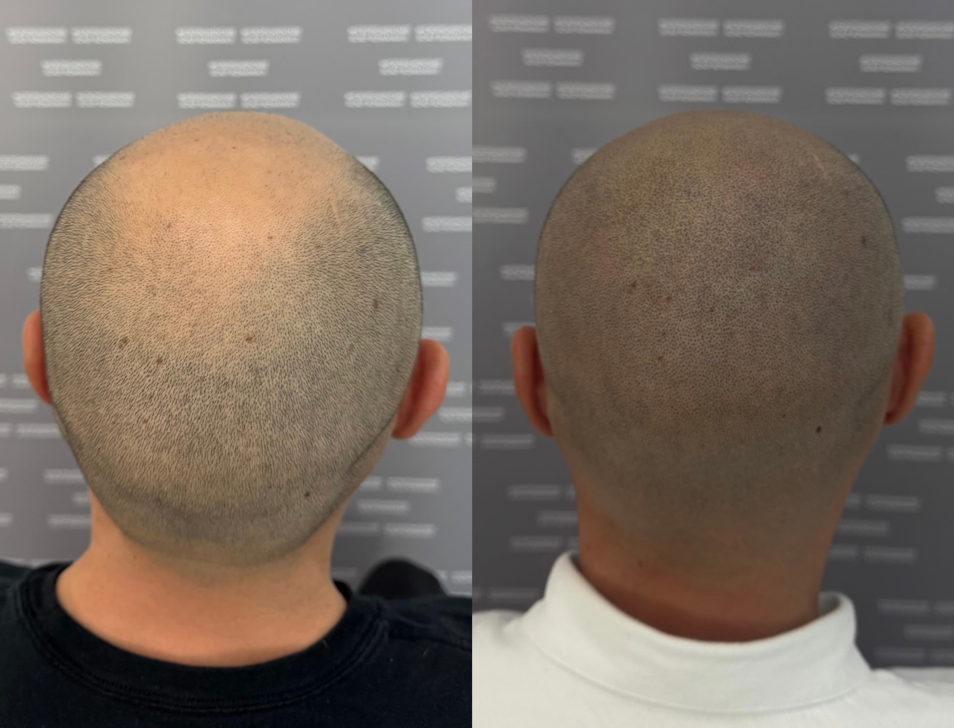 Perspectivă micropigmentare scalp - Alopecie Androgenetică