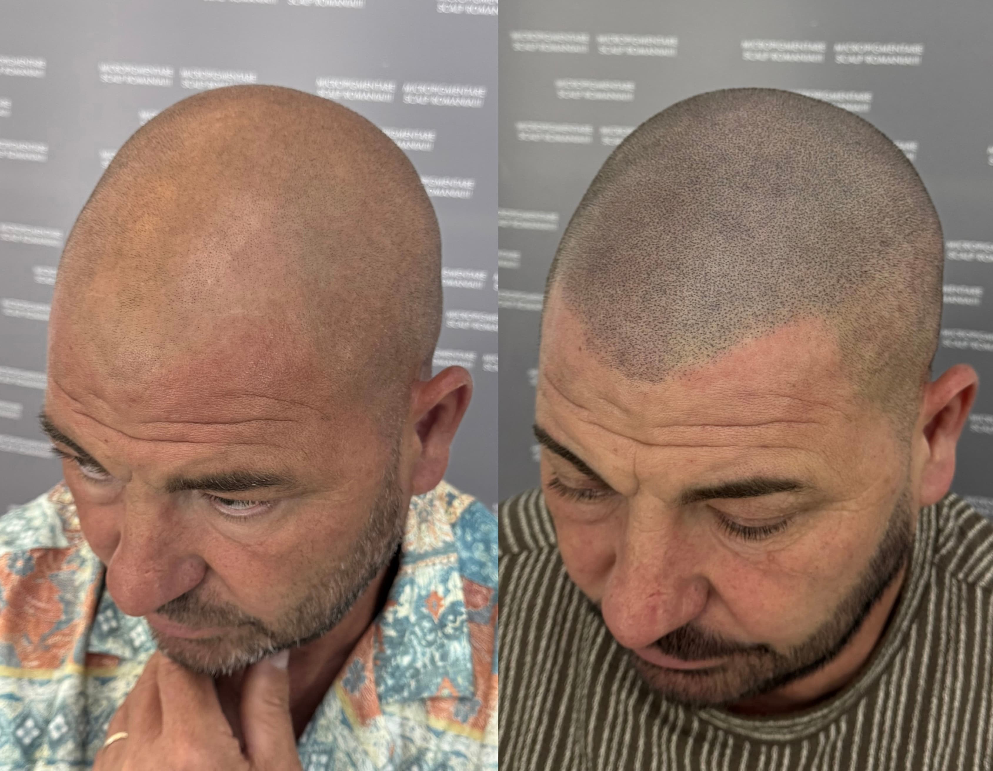 Perspectivă micropigmentare scalp - Alopecie Androgenetică