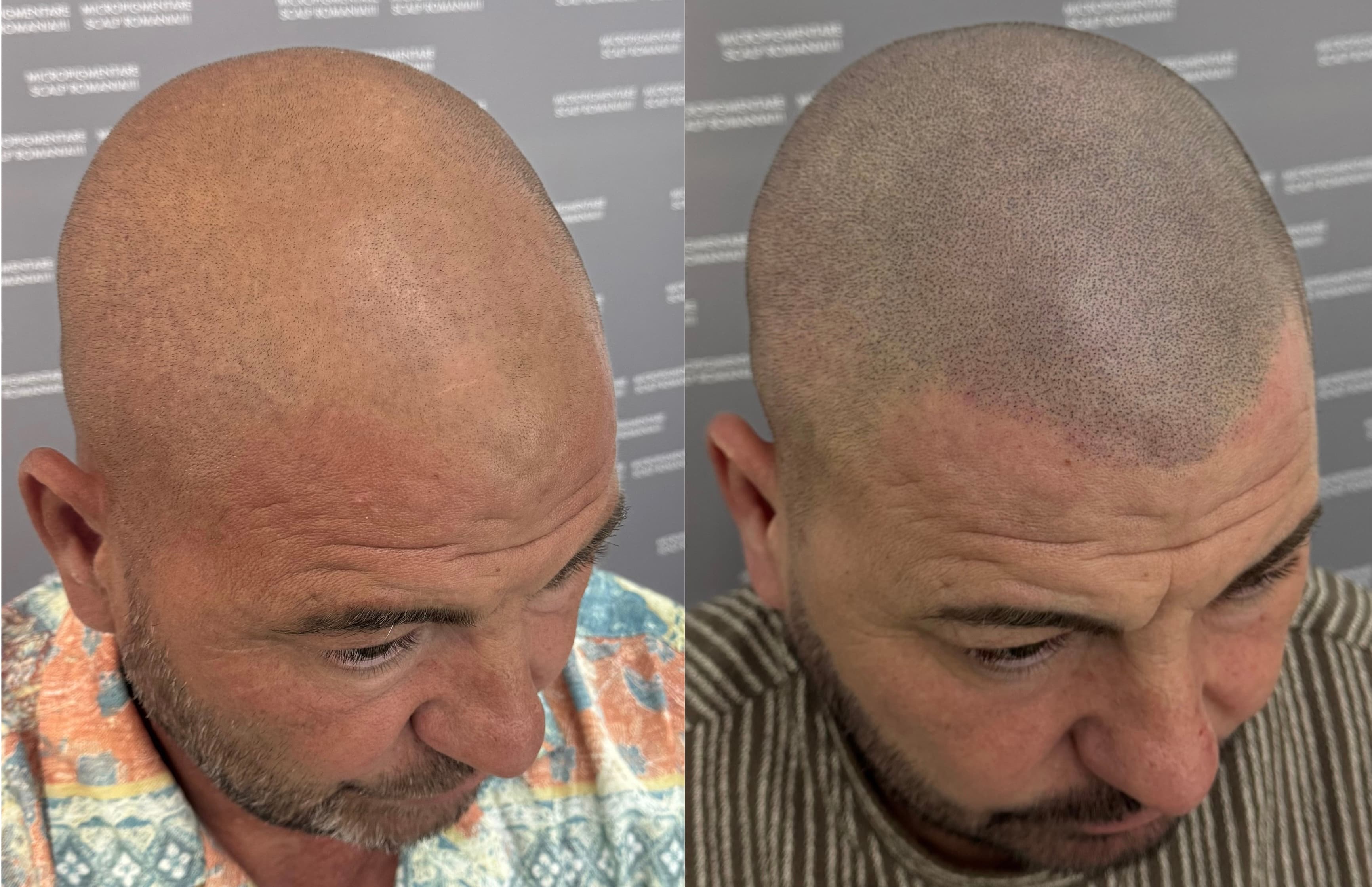 Perspectivă micropigmentare scalp - Alopecie Androgenetică