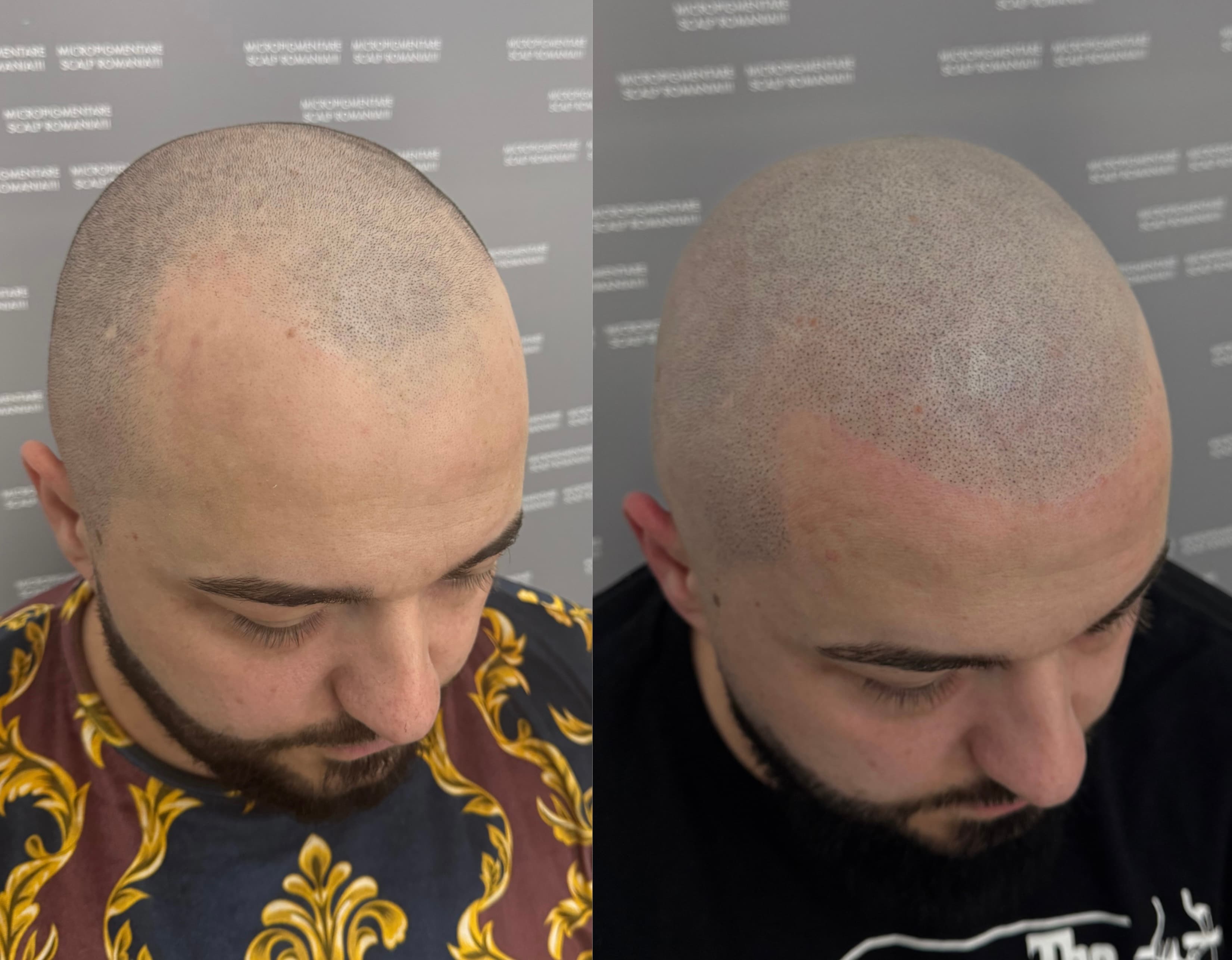 Perspectivă micropigmentare scalp - Alopecie Androgenetică