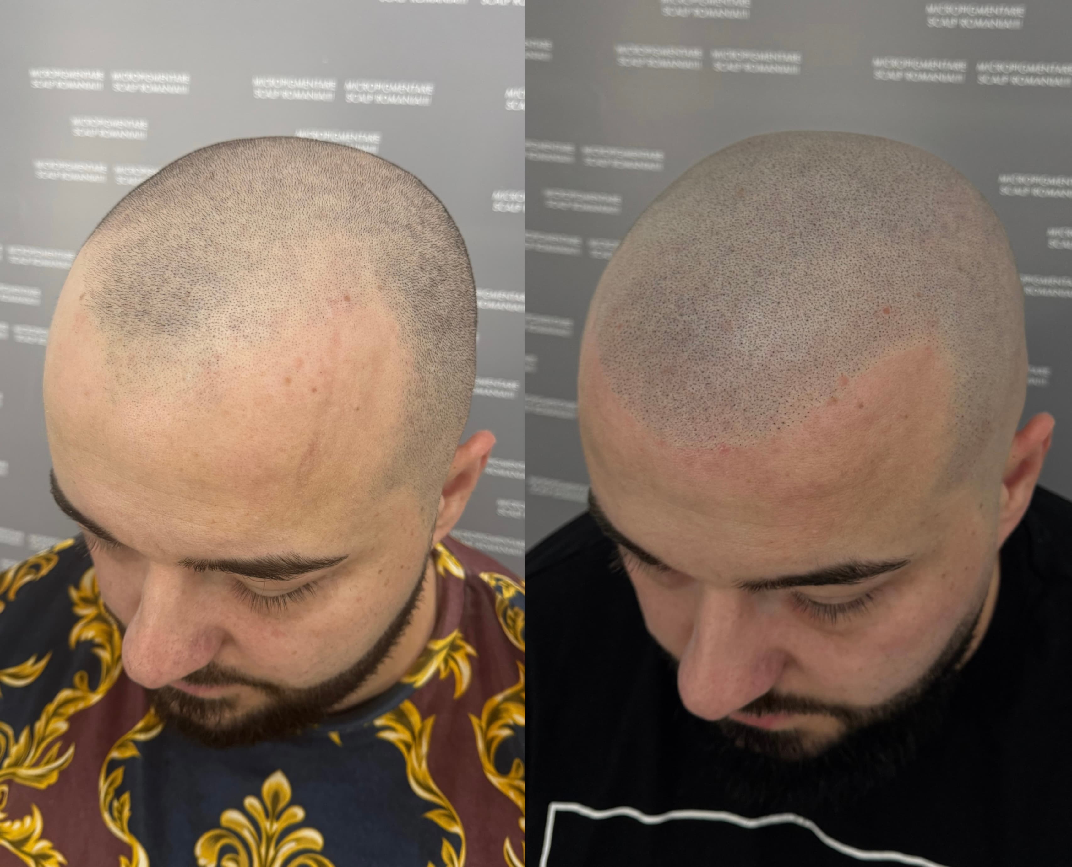 Perspectivă micropigmentare scalp - Alopecie Androgenetică