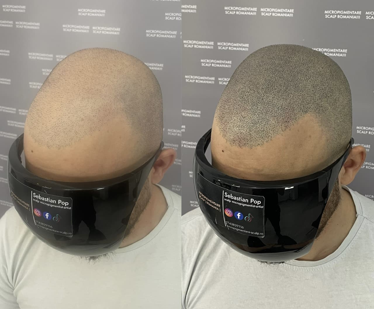 Perspectivă micropigmentare scalp - Densitate Post Transplant