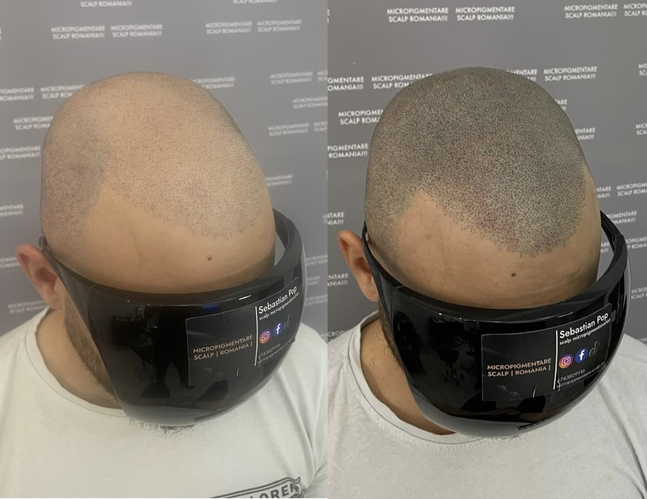 Perspectivă micropigmentare scalp - Densitate Post Transplant