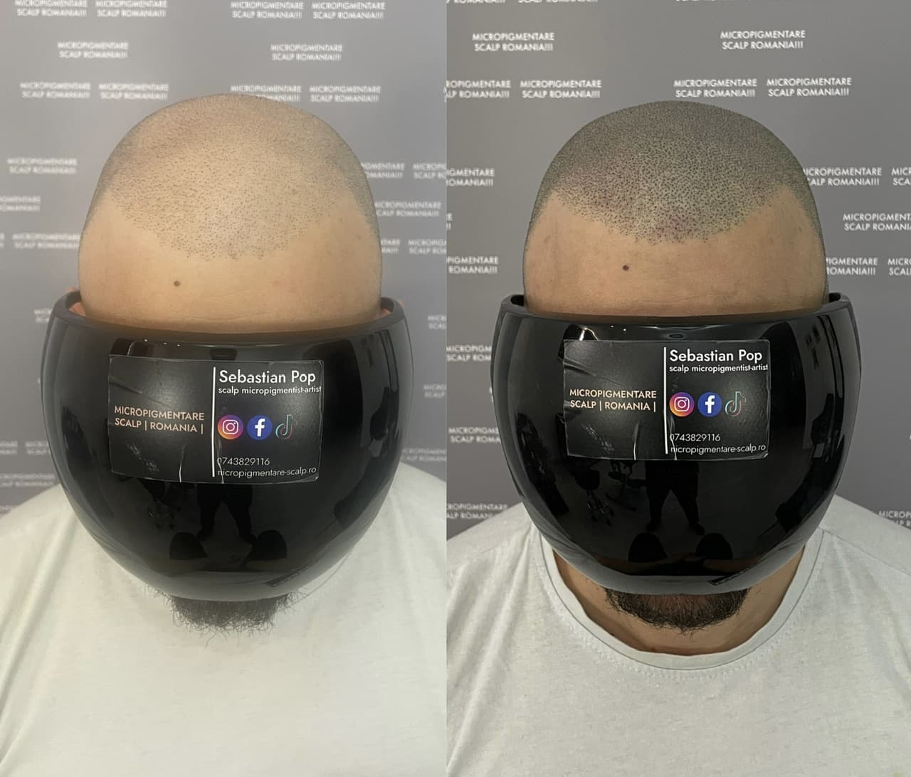 Perspectivă micropigmentare scalp - Densitate Post Transplant