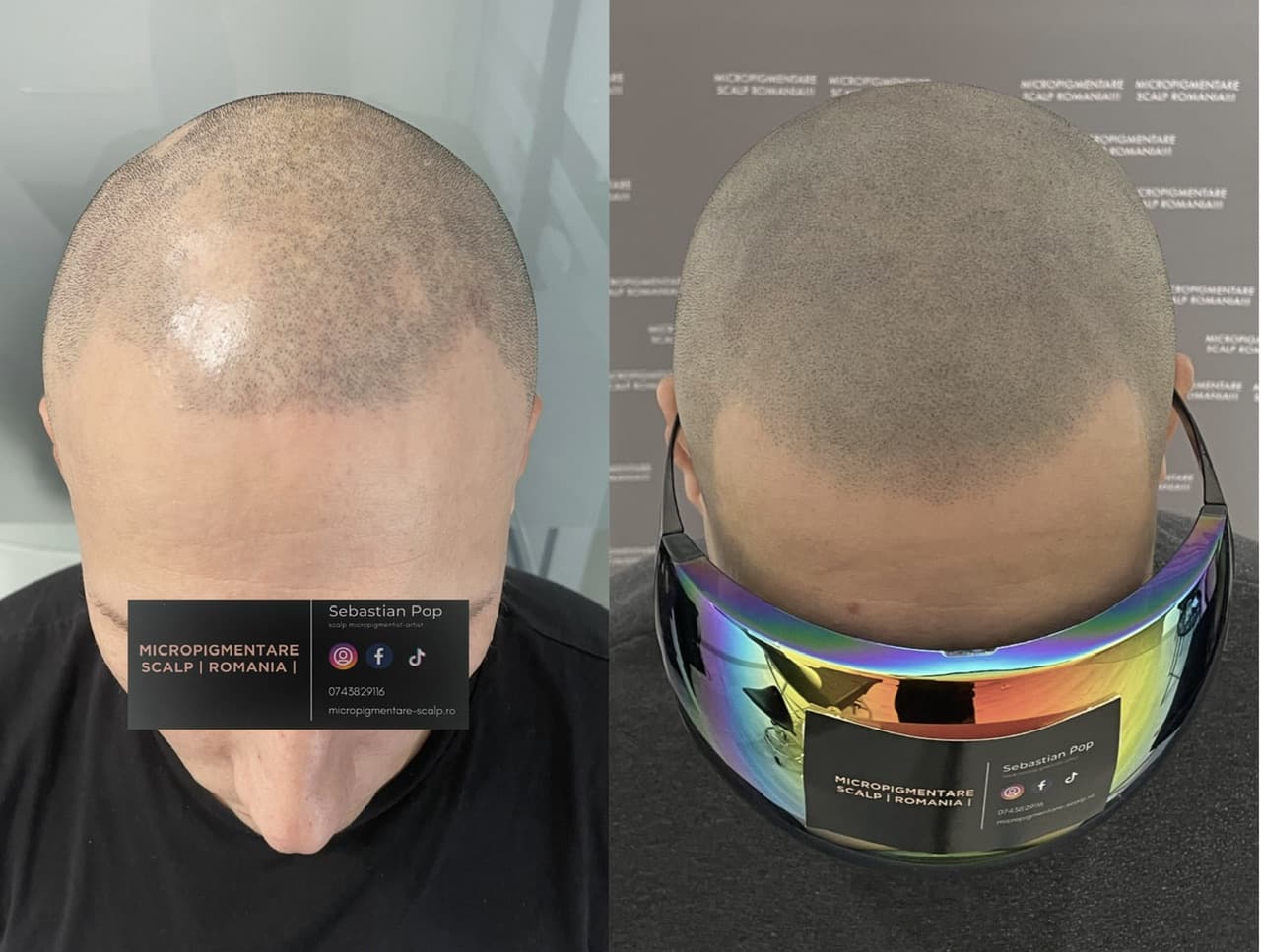 Perspectivă micropigmentare scalp - Alopecie Areată