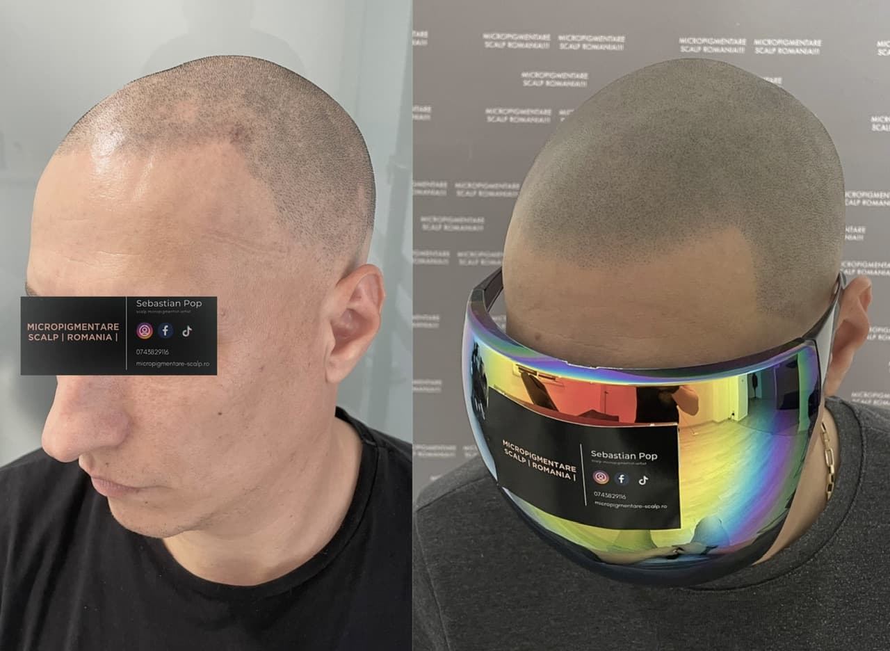 Perspectivă micropigmentare scalp - Alopecie Areată