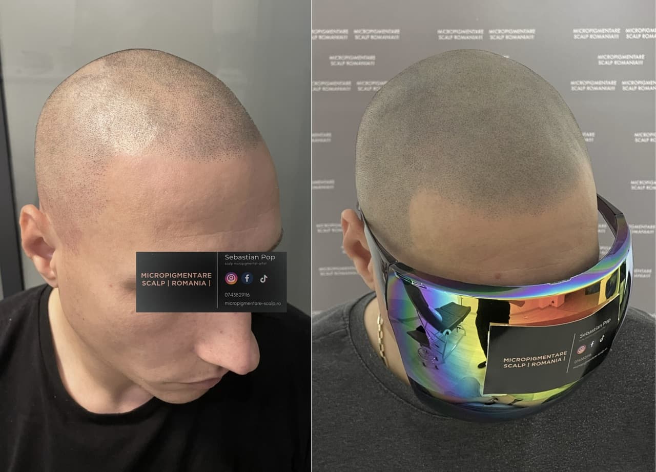 Perspectivă micropigmentare scalp - Alopecie Areată