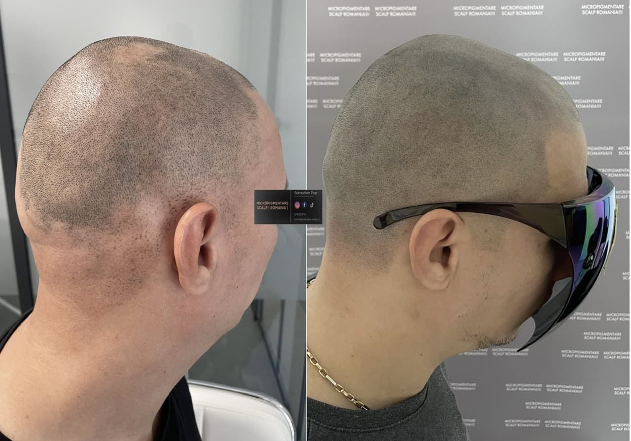 Perspectivă micropigmentare scalp - Alopecie Areată