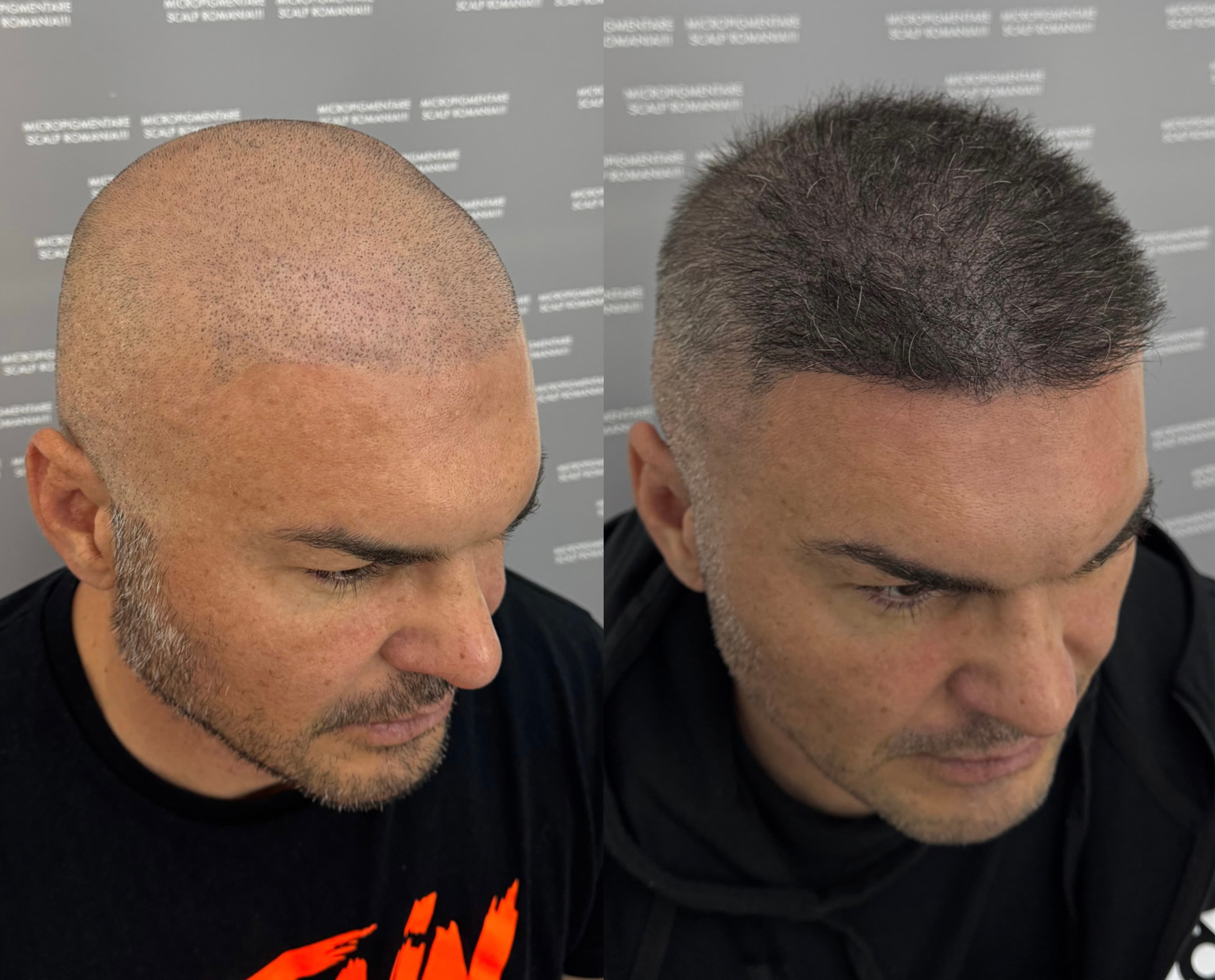Perspectivă micropigmentare scalp - Densitate Post Transplant