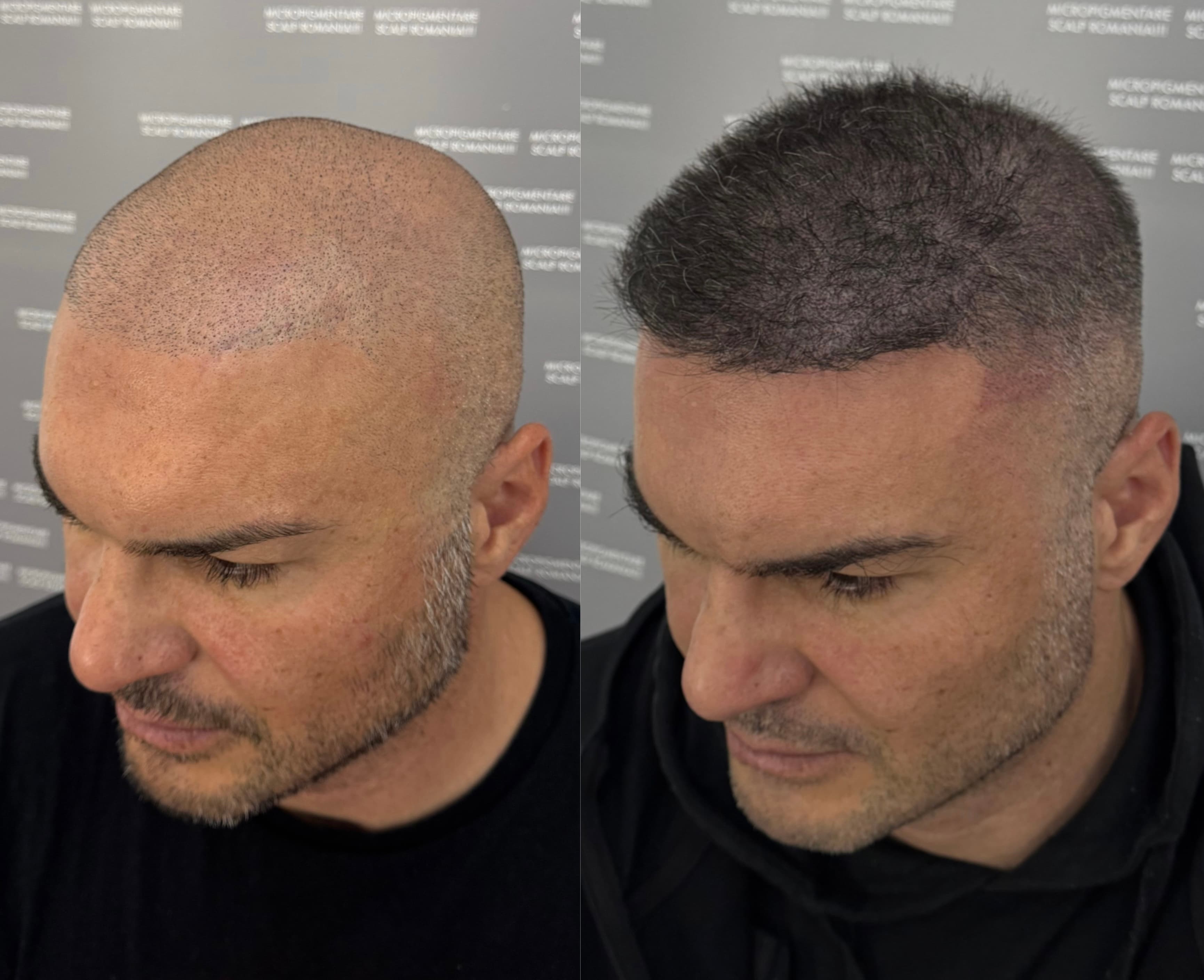 Perspectivă micropigmentare scalp - Densitate Post Transplant