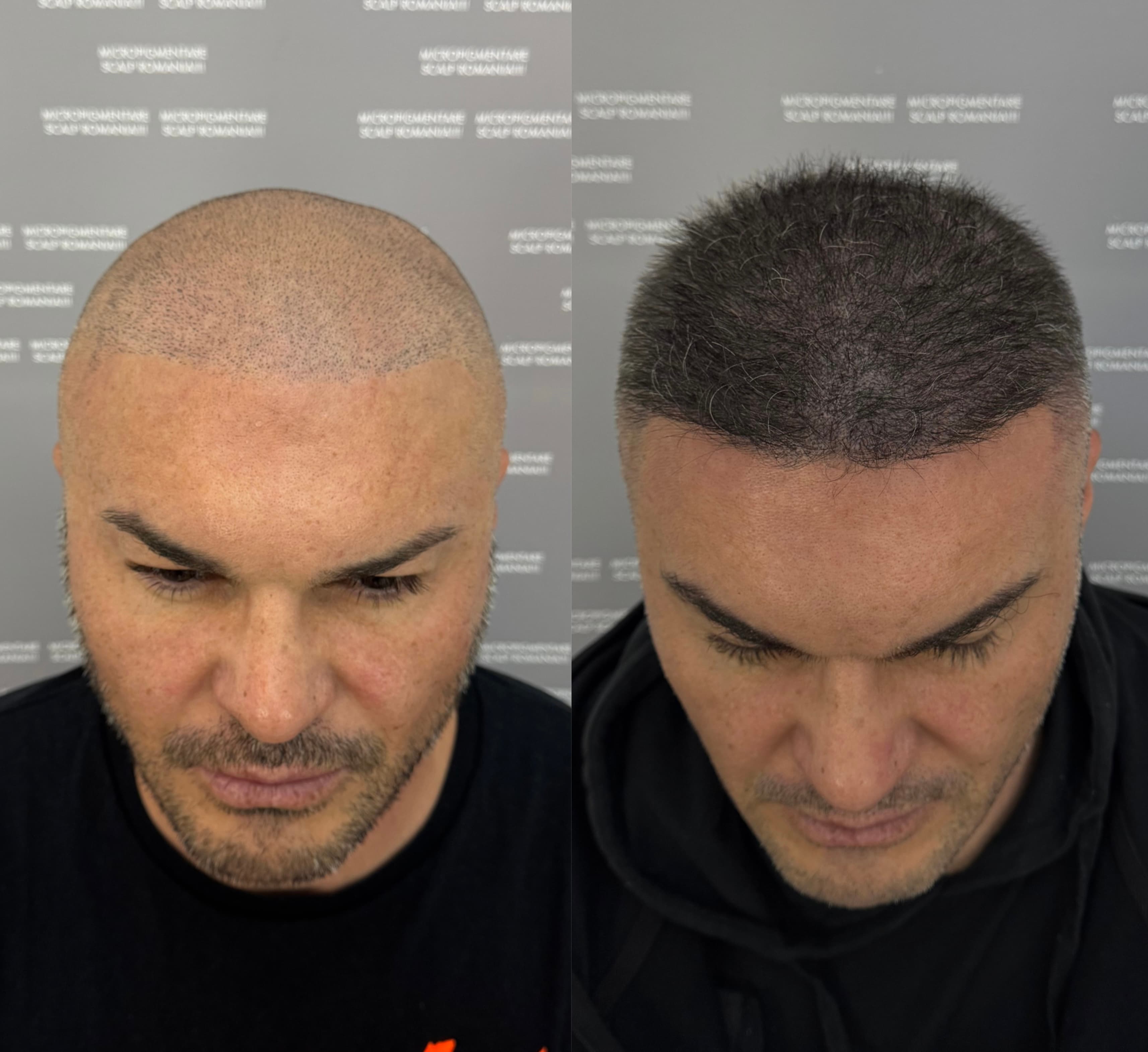 Perspectivă micropigmentare scalp - Densitate Post Transplant