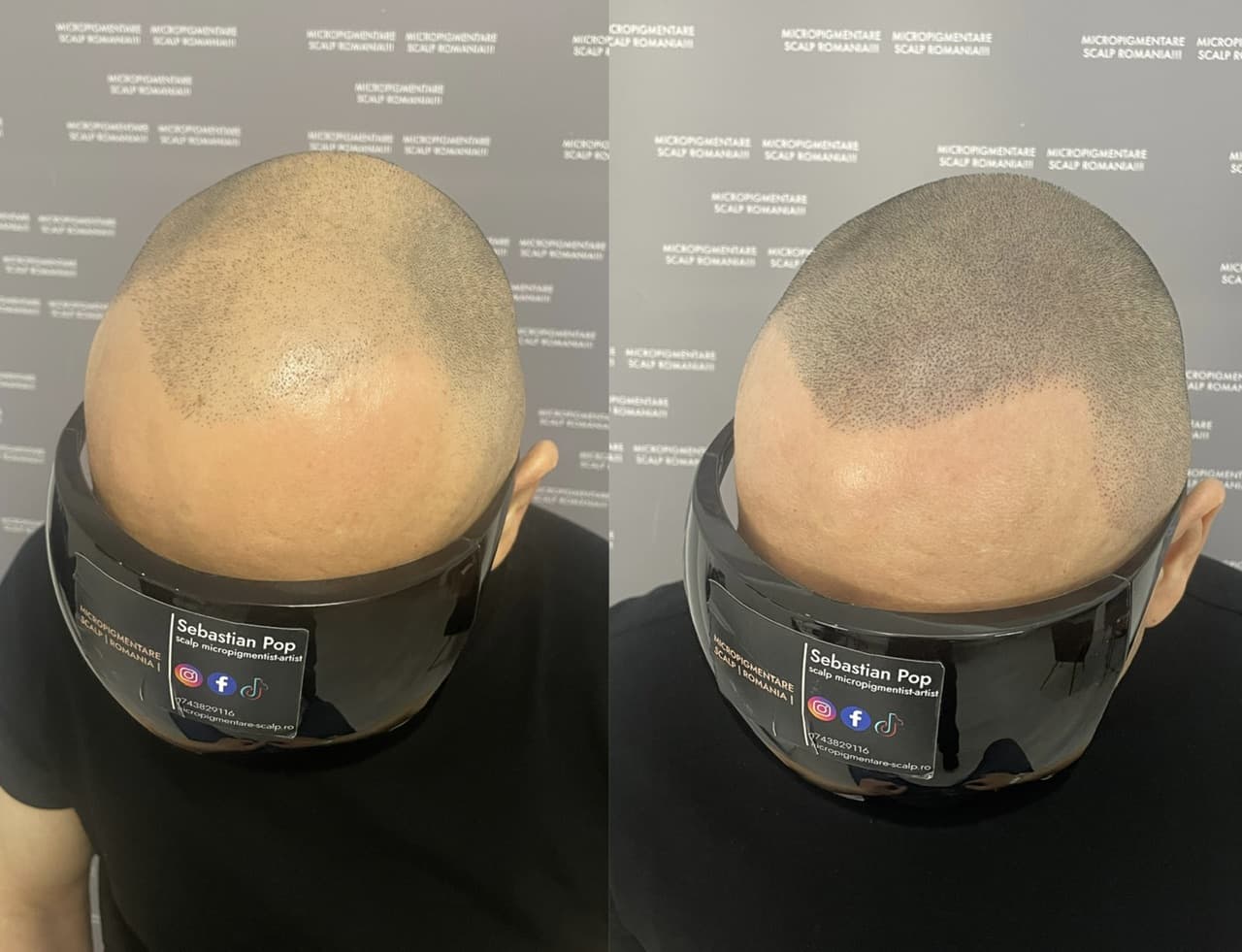 Perspectivă micropigmentare scalp - Densitate Post Transplant