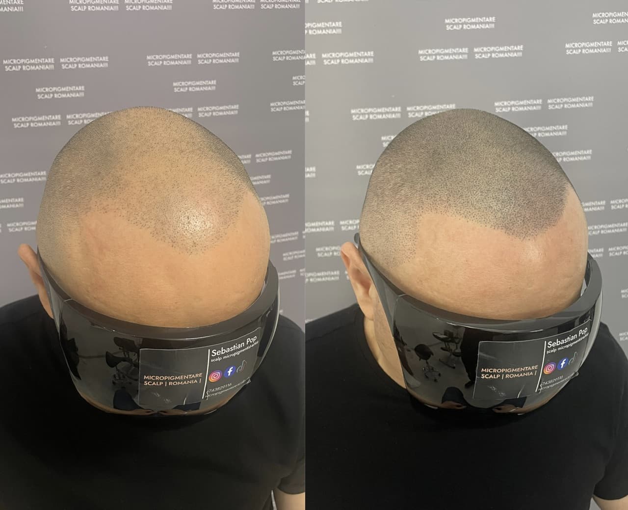 Perspectivă micropigmentare scalp - Densitate Post Transplant