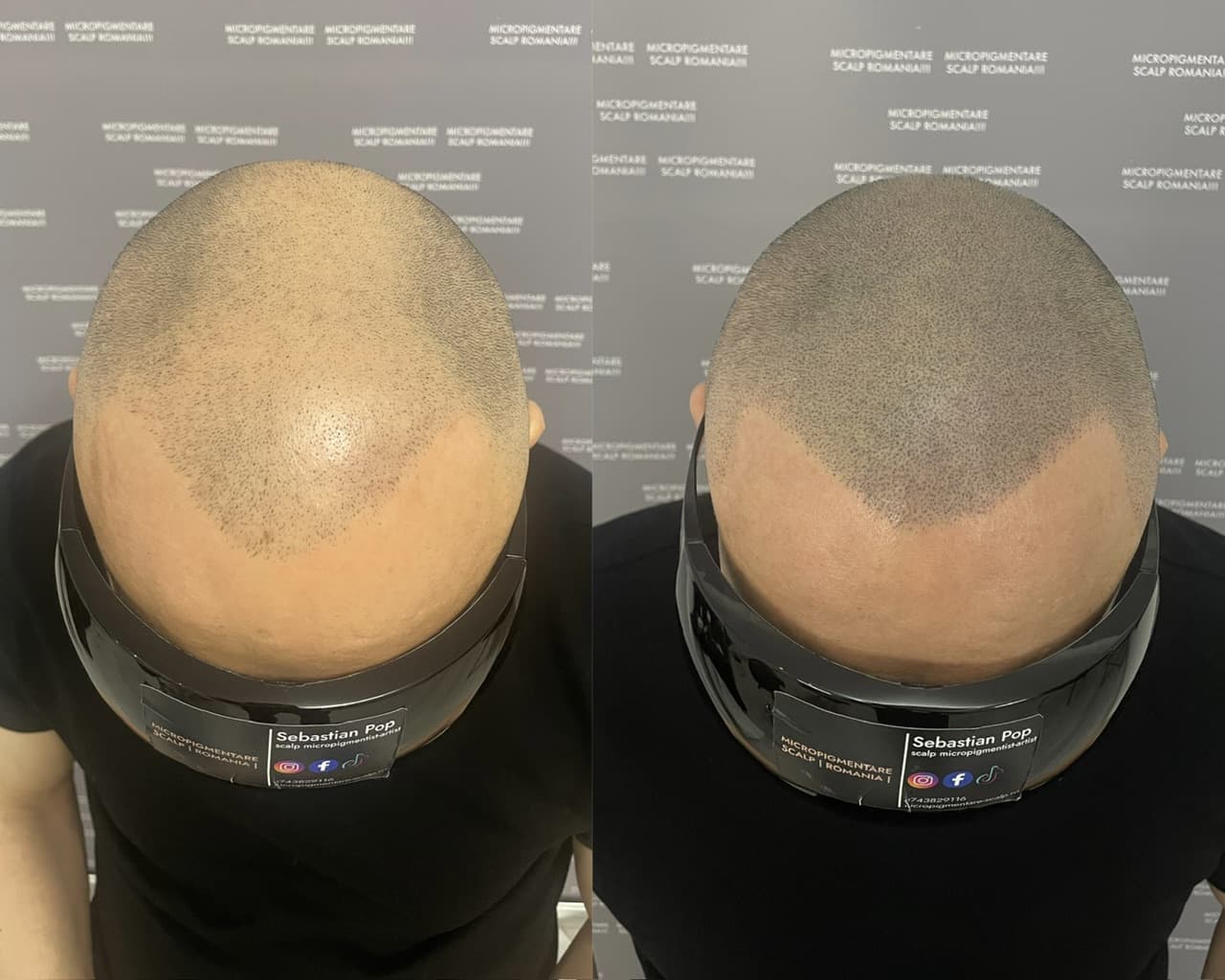 Perspectivă micropigmentare scalp - Densitate Post Transplant