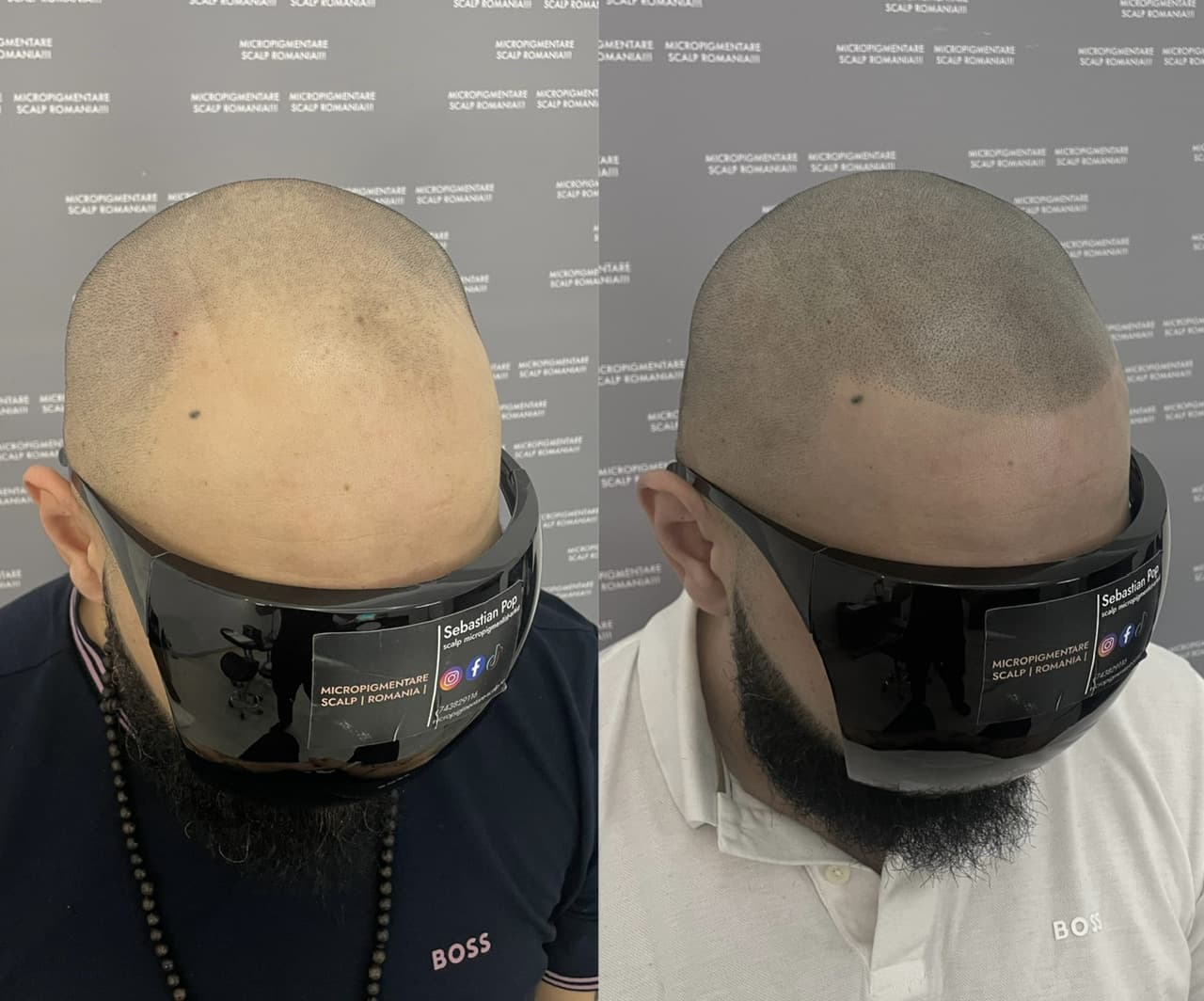 Perspectivă micropigmentare scalp - Alopecie Androgenetică