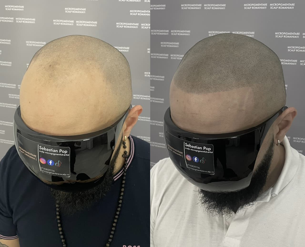 Perspectivă micropigmentare scalp - Alopecie Androgenetică