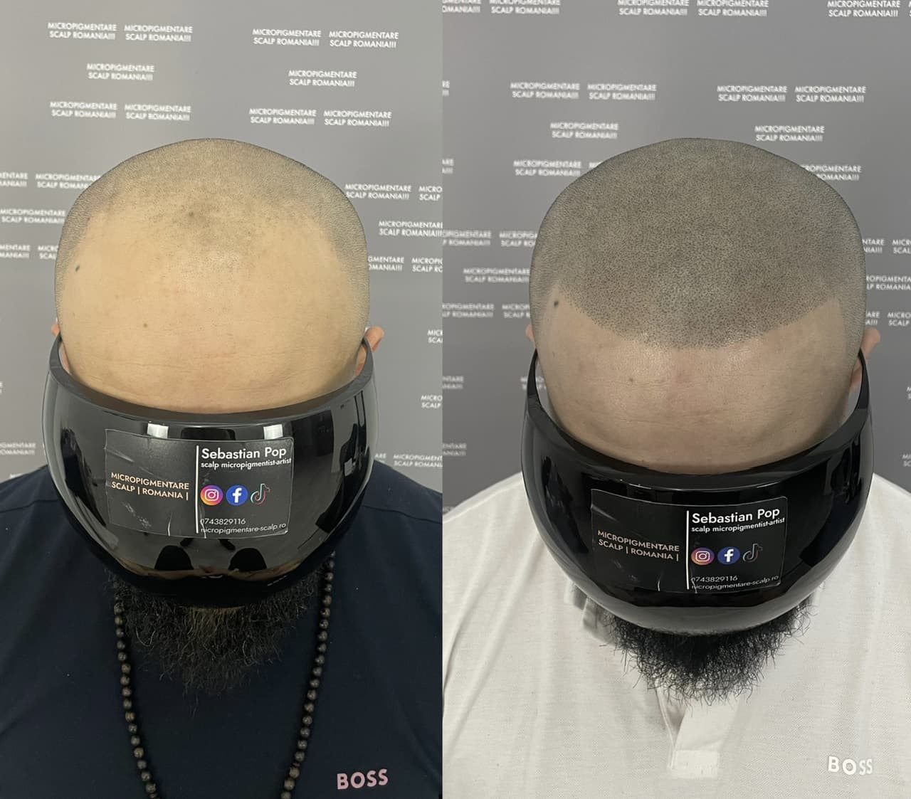 Perspectivă micropigmentare scalp - Alopecie Androgenetică