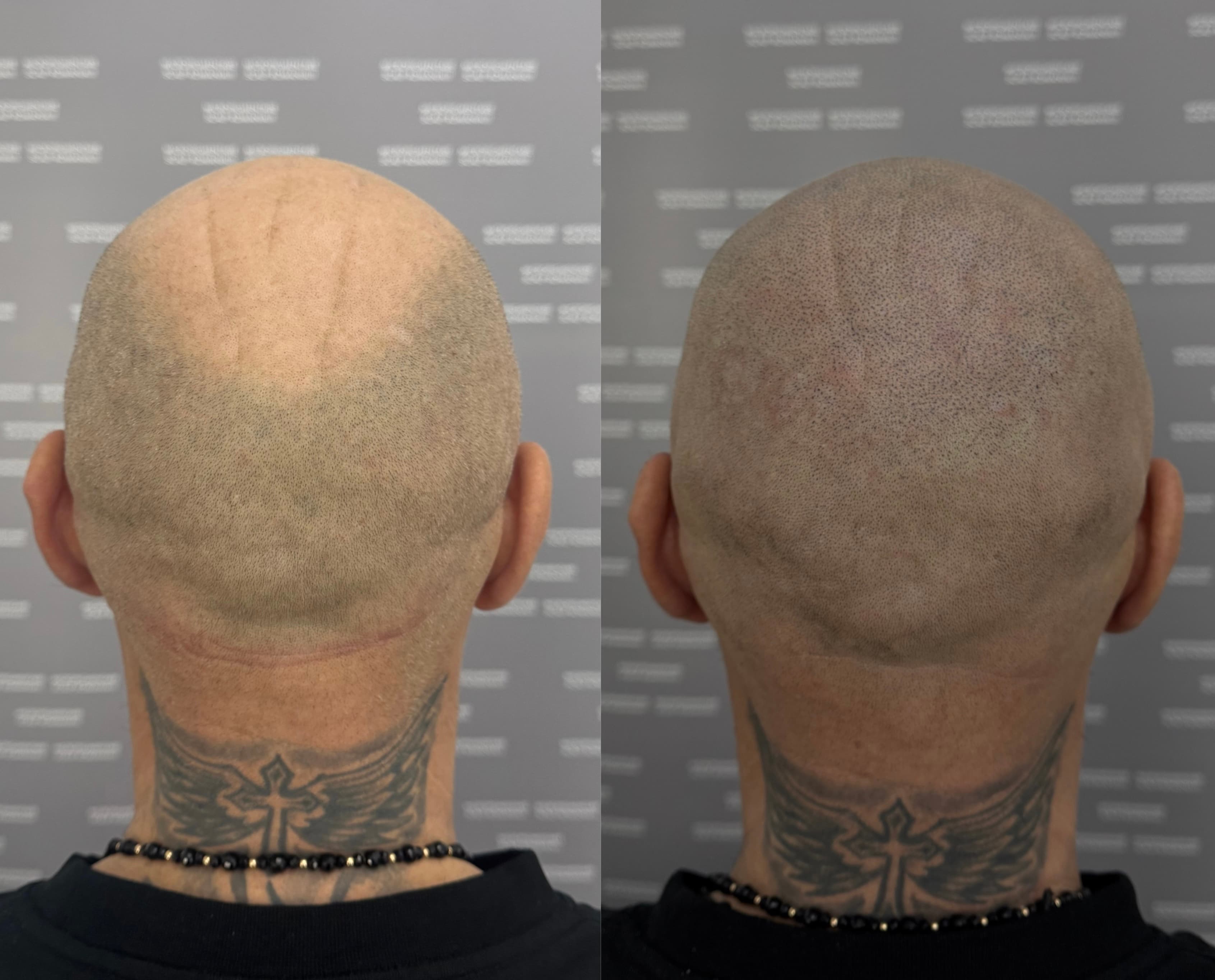 Perspectivă micropigmentare scalp - Alopecie Androgenetică