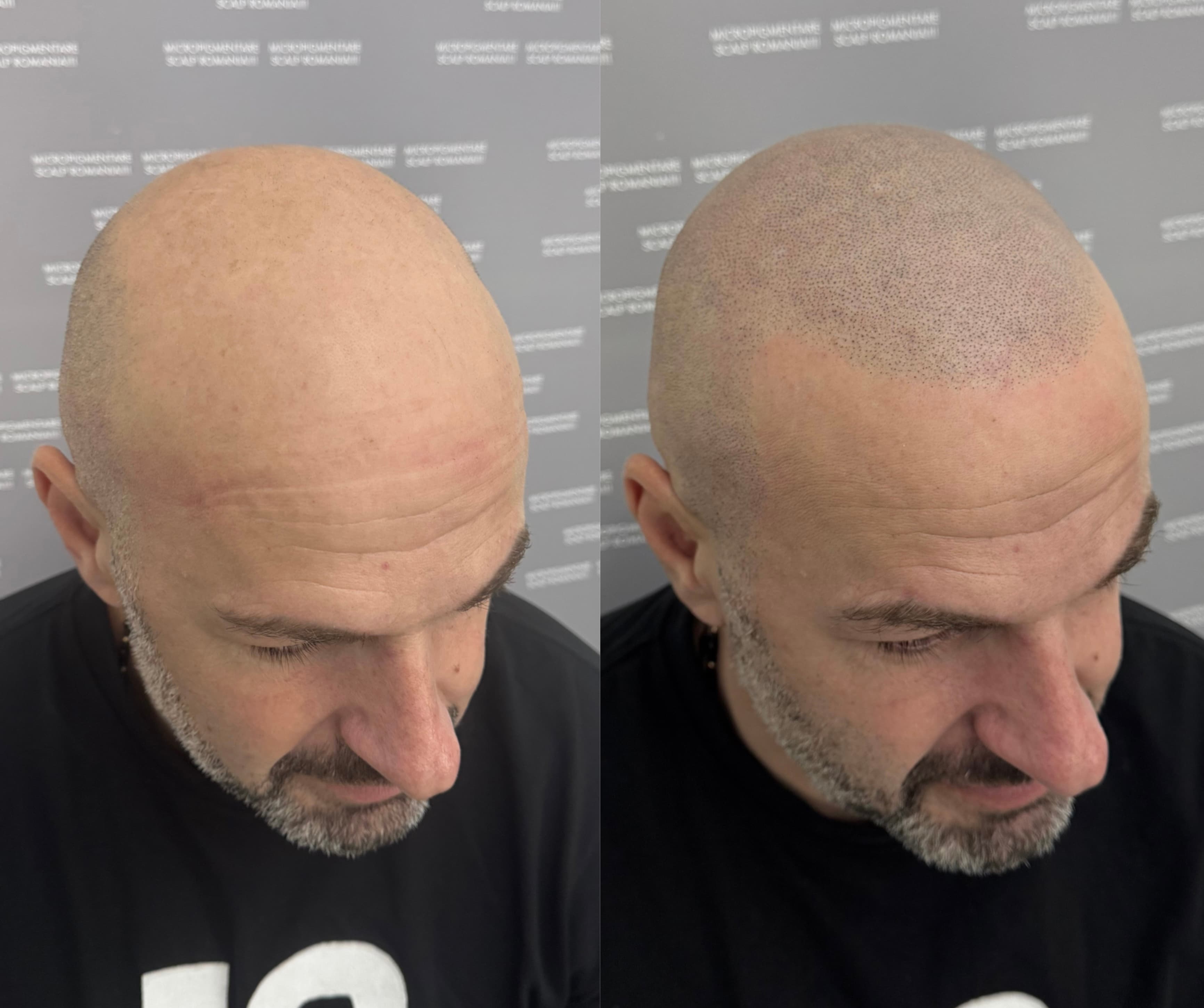 Perspectivă micropigmentare scalp - Alopecie Androgenetică