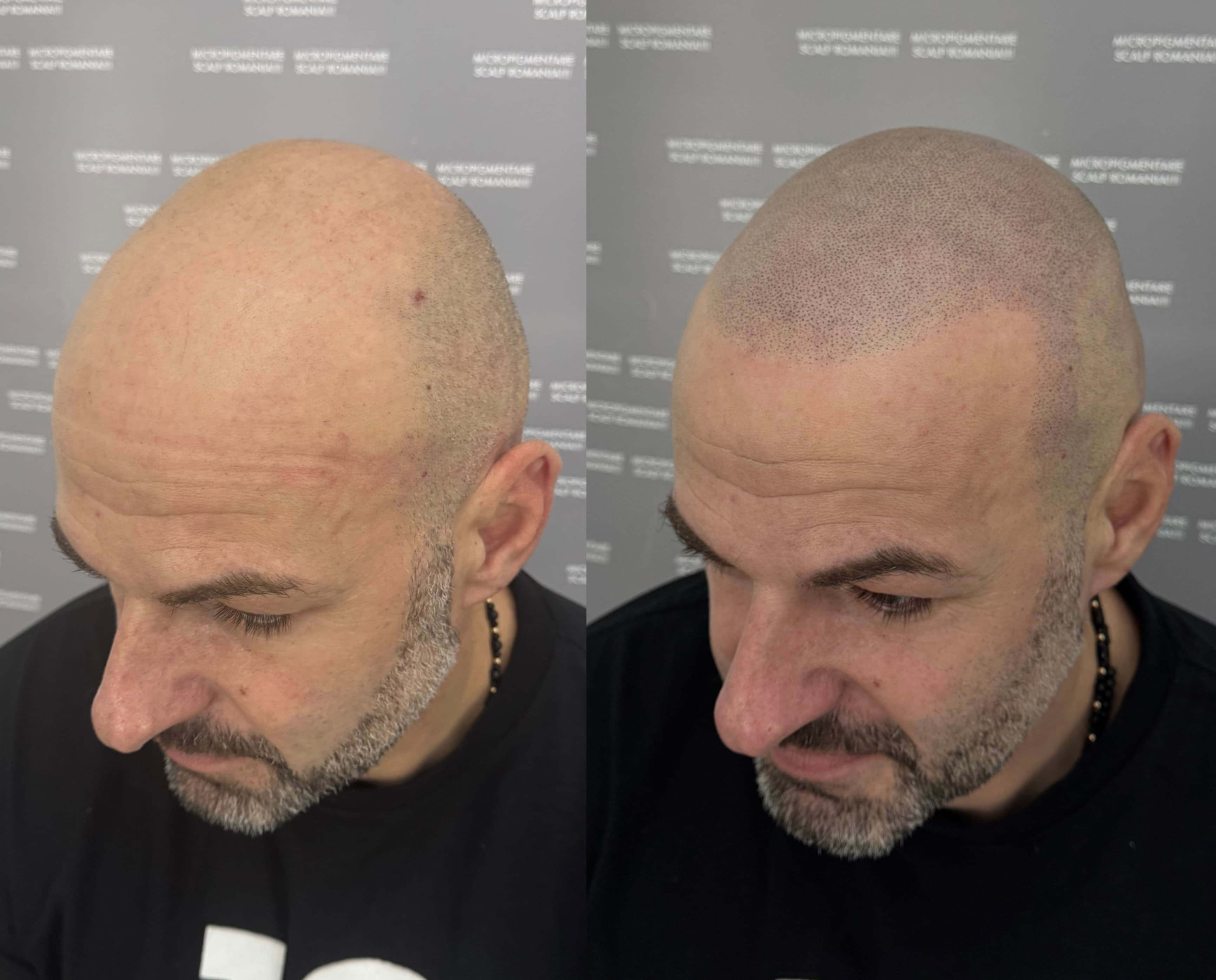 Perspectivă micropigmentare scalp - Alopecie Androgenetică