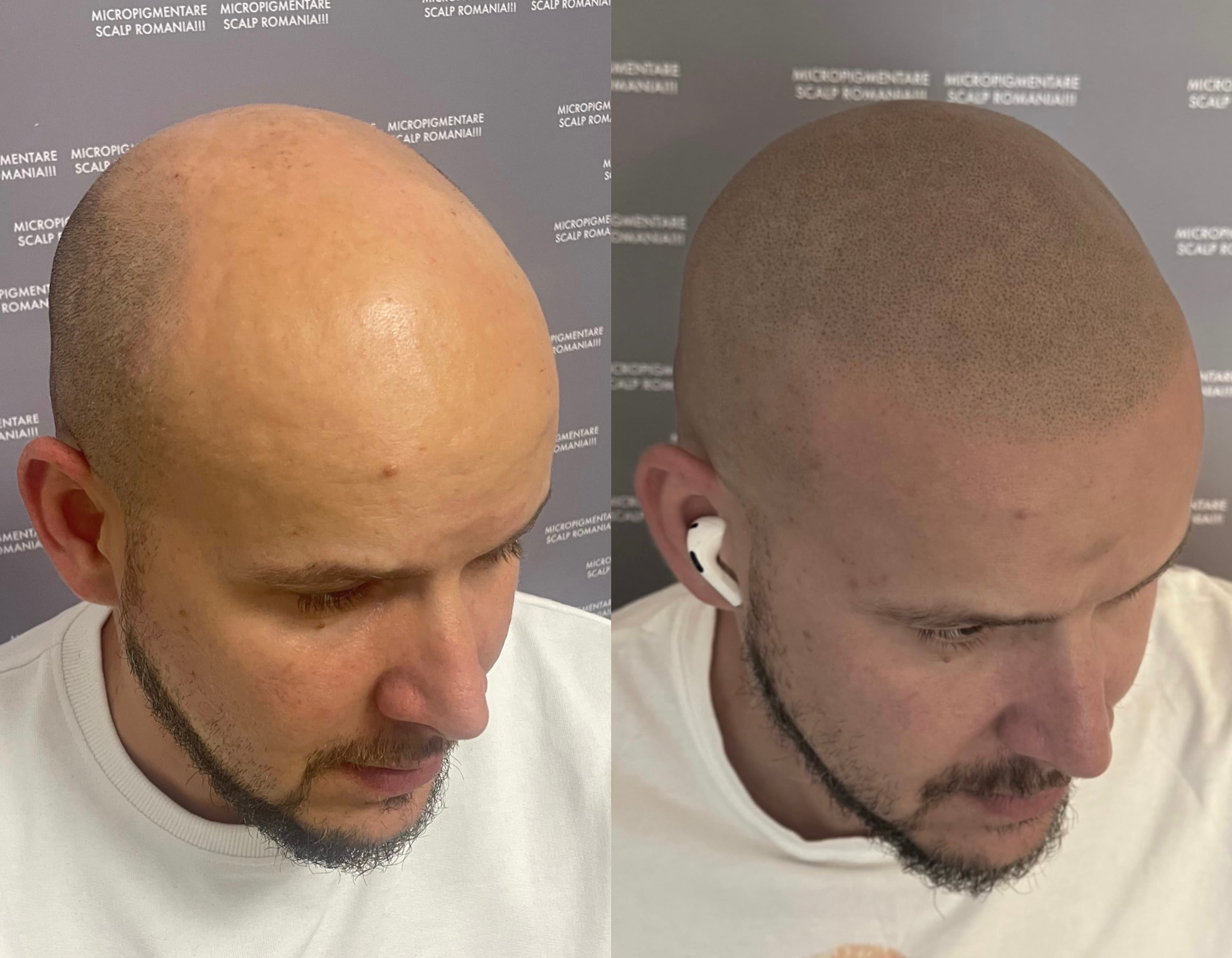 Perspectivă micropigmentare scalp - Alopecie Androgenetică