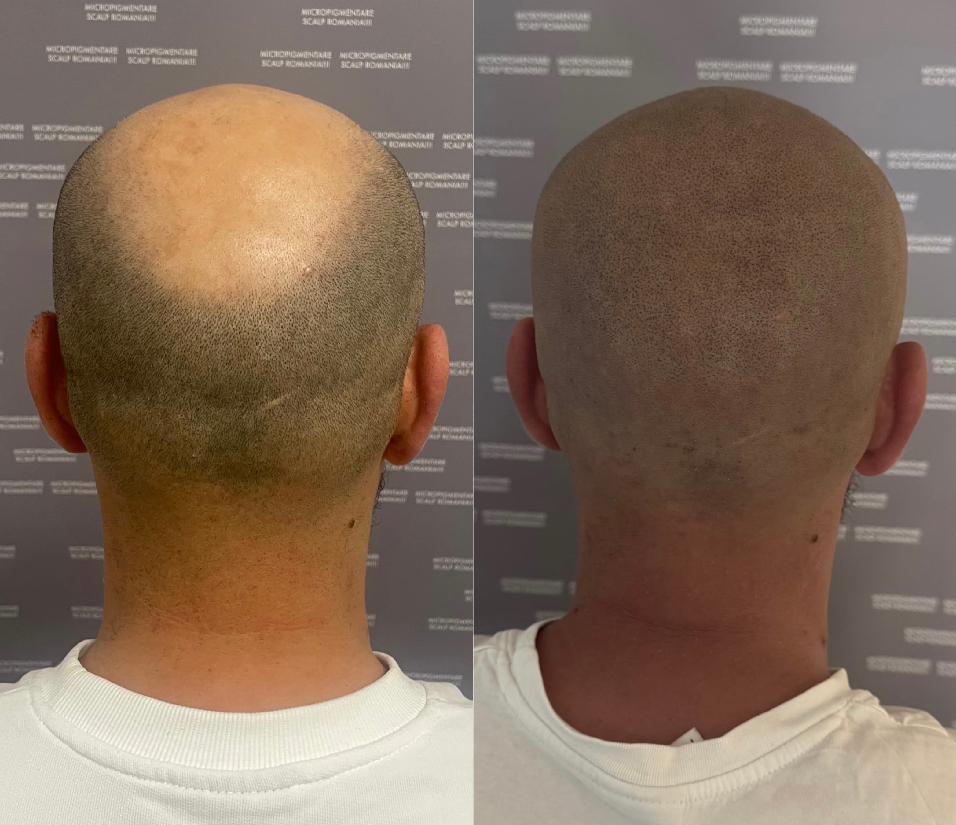 Perspectivă micropigmentare scalp - Alopecie Androgenetică