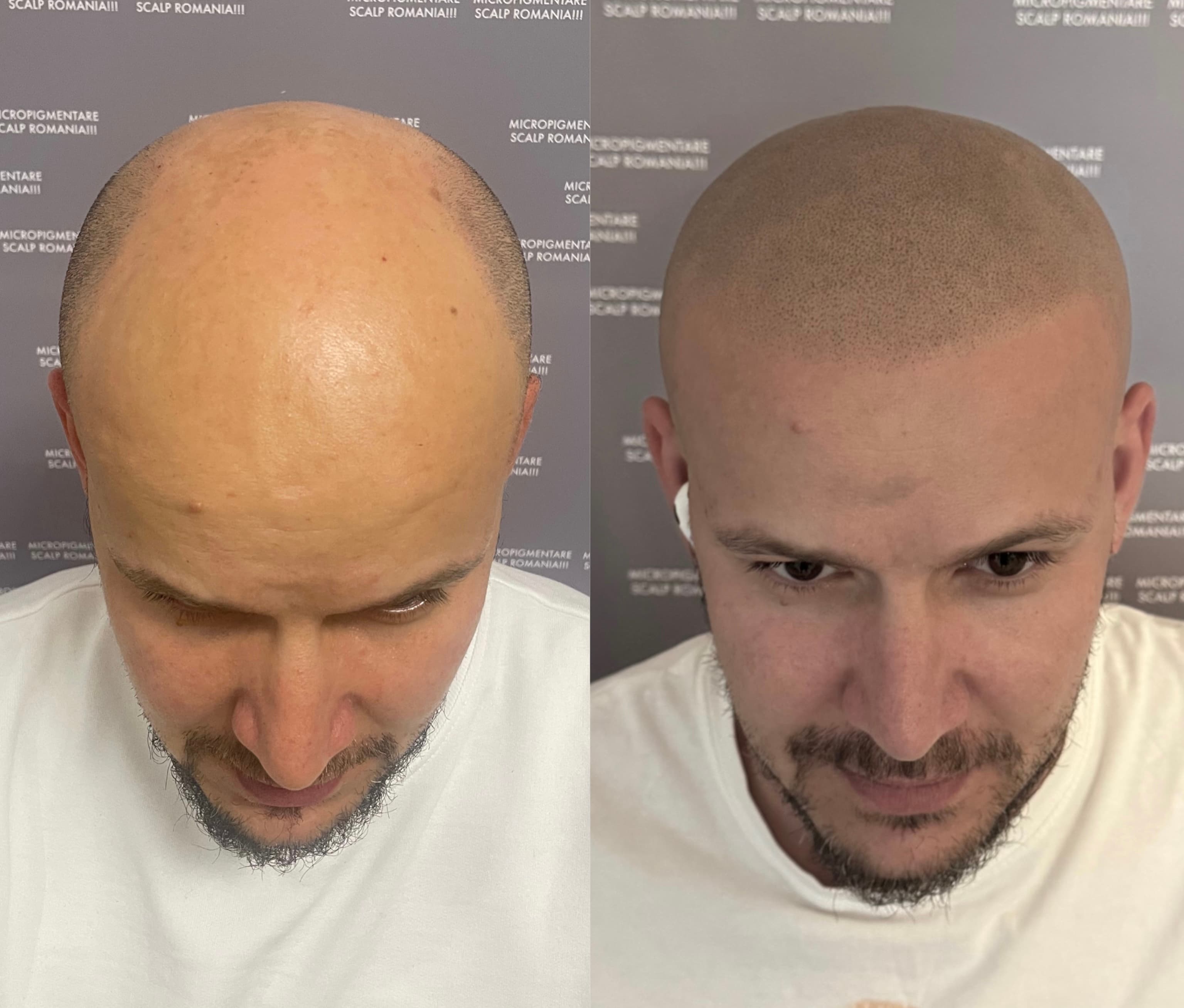 Perspectivă micropigmentare scalp - Alopecie Androgenetică