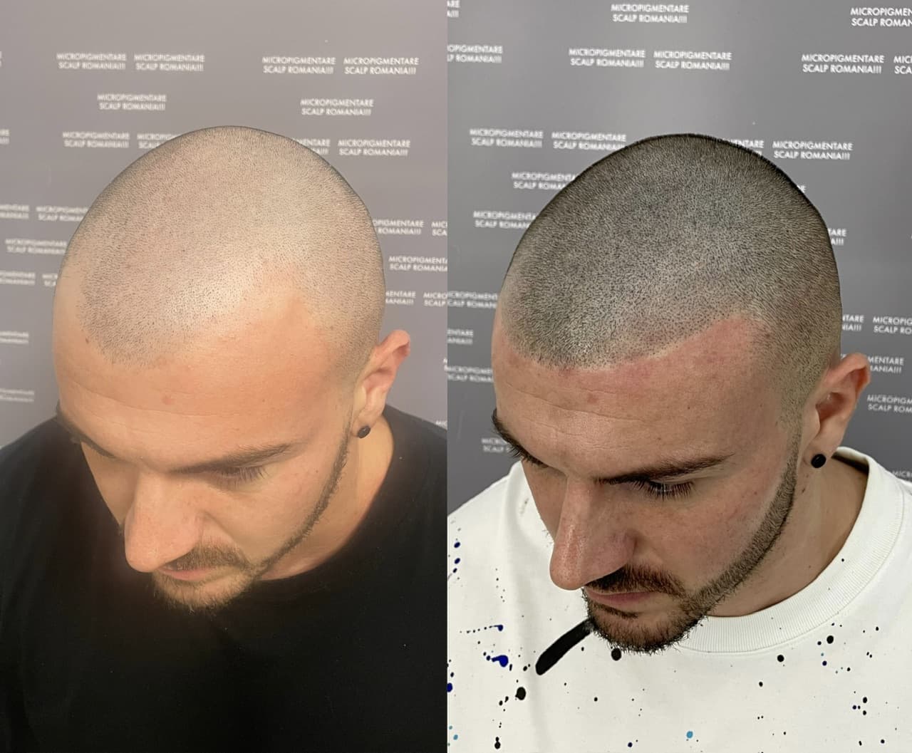 Perspectivă micropigmentare scalp - Densitate Post Transplant