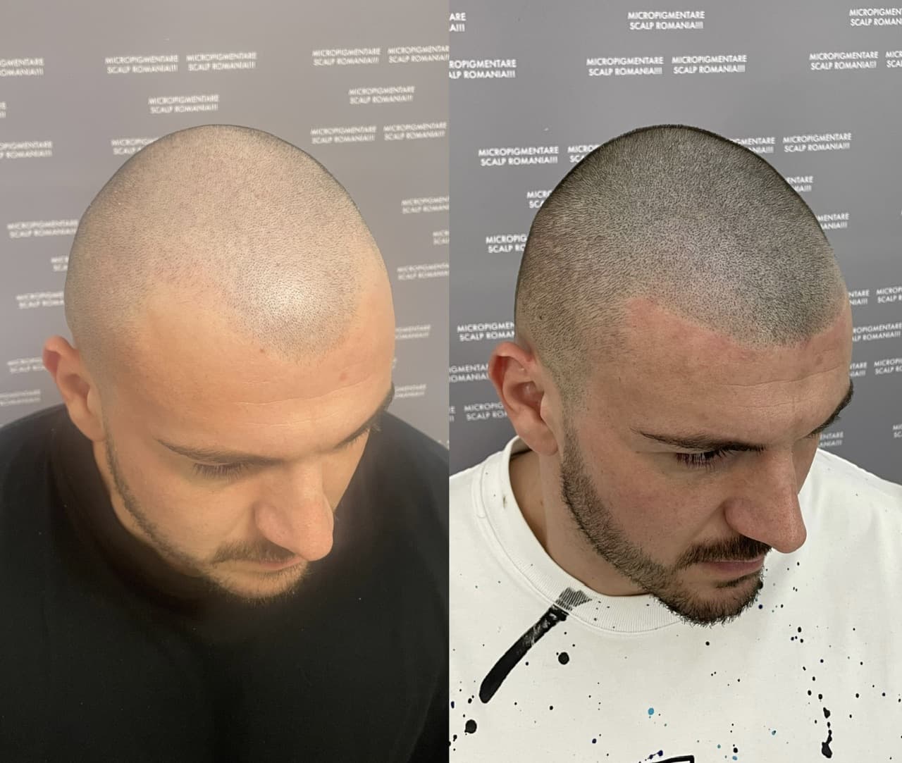 Perspectivă micropigmentare scalp - Densitate Post Transplant