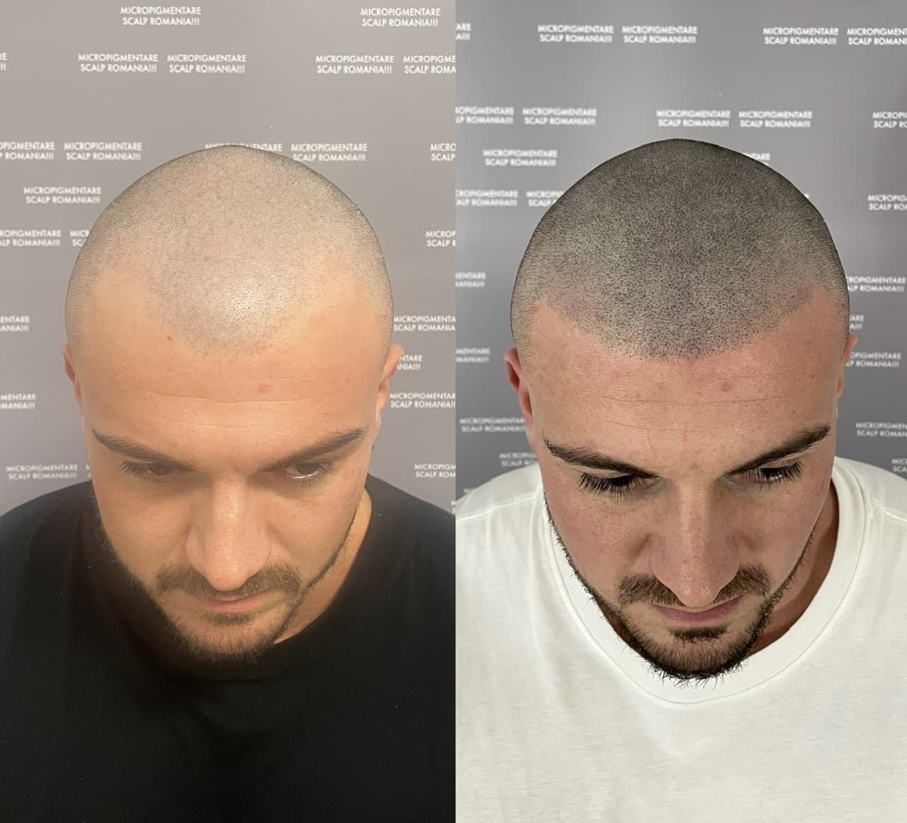 Perspectivă micropigmentare scalp - Densitate Post Transplant