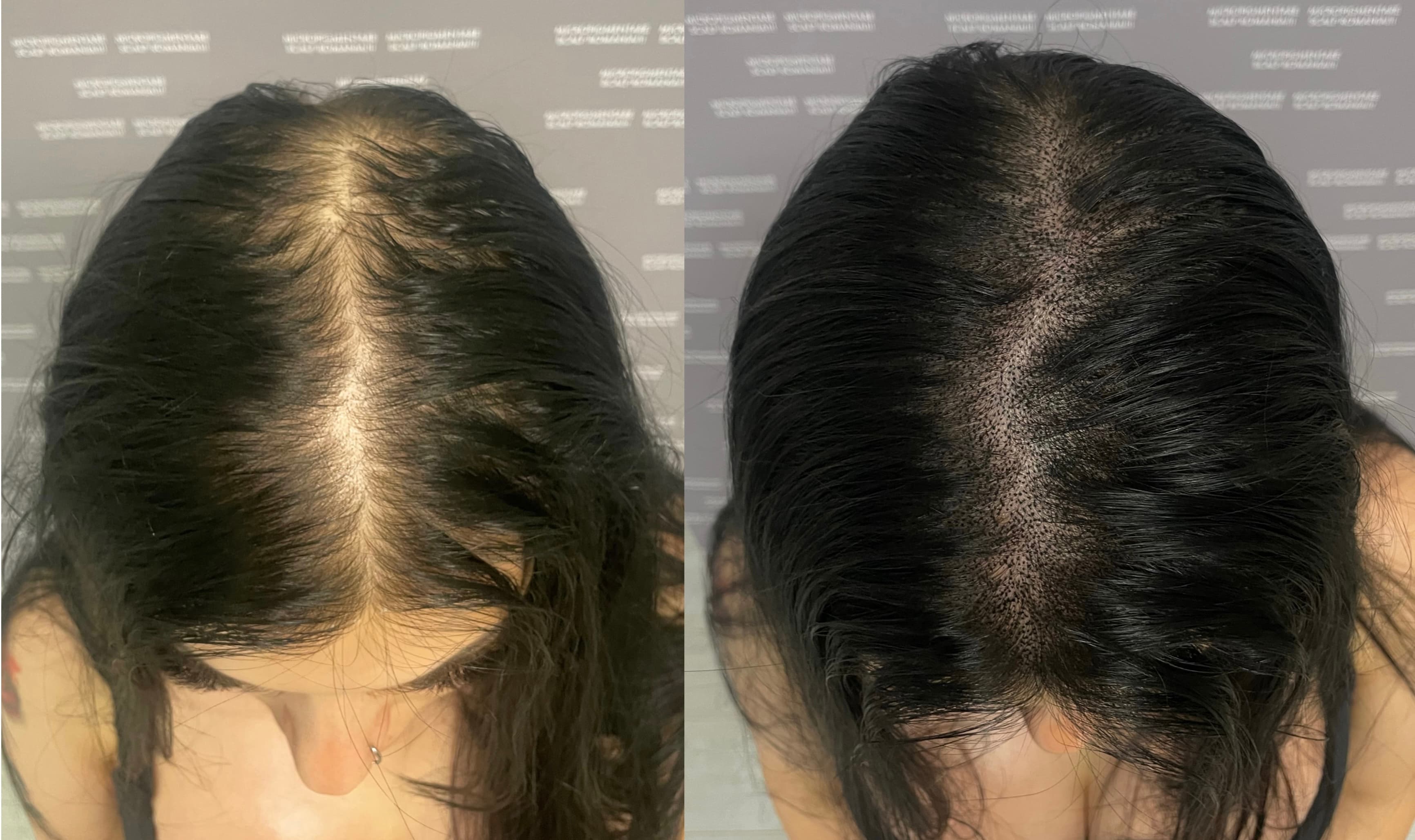 Perspectivă micropigmentare scalp - Micropigmentare Scalp Femei