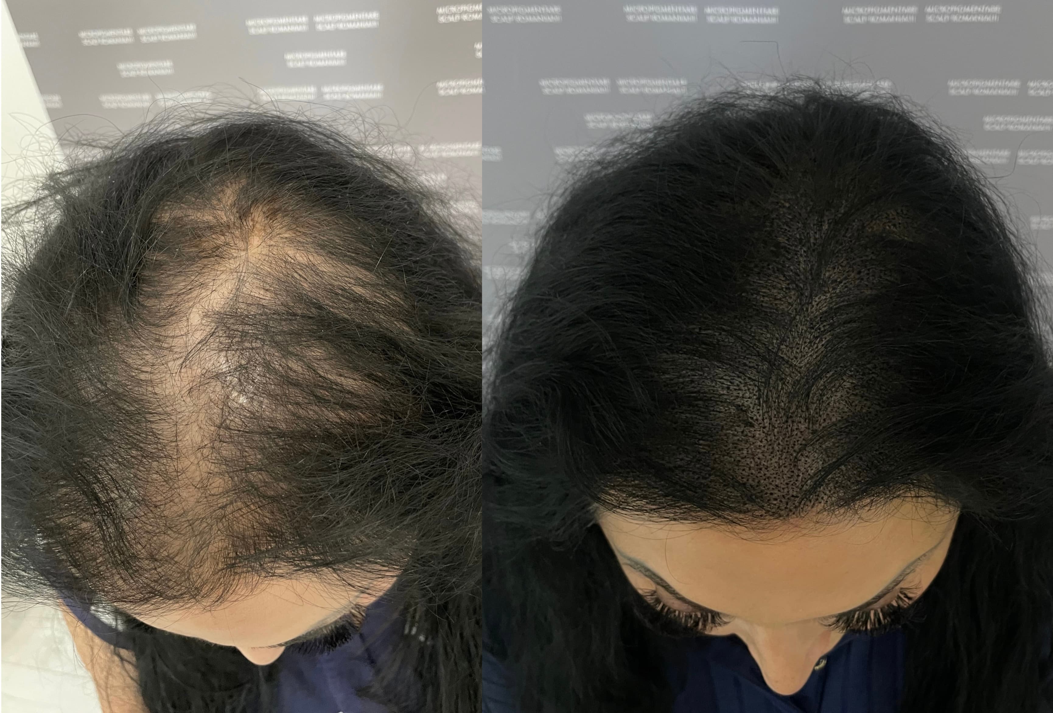 Perspectivă micropigmentare scalp - Micropigmentare Scalp Femei