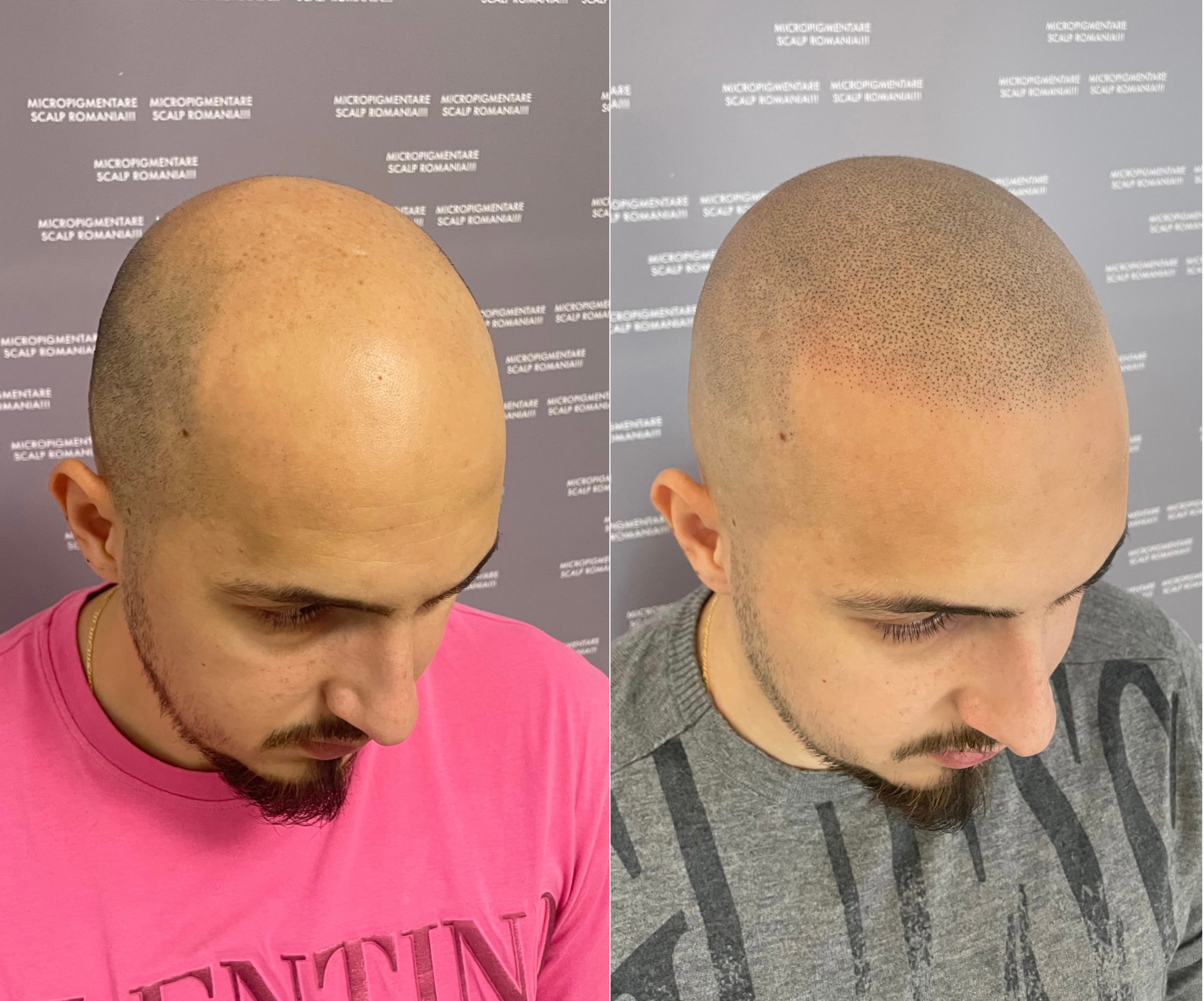 Perspectivă micropigmentare scalp - Alopecie Androgenetică