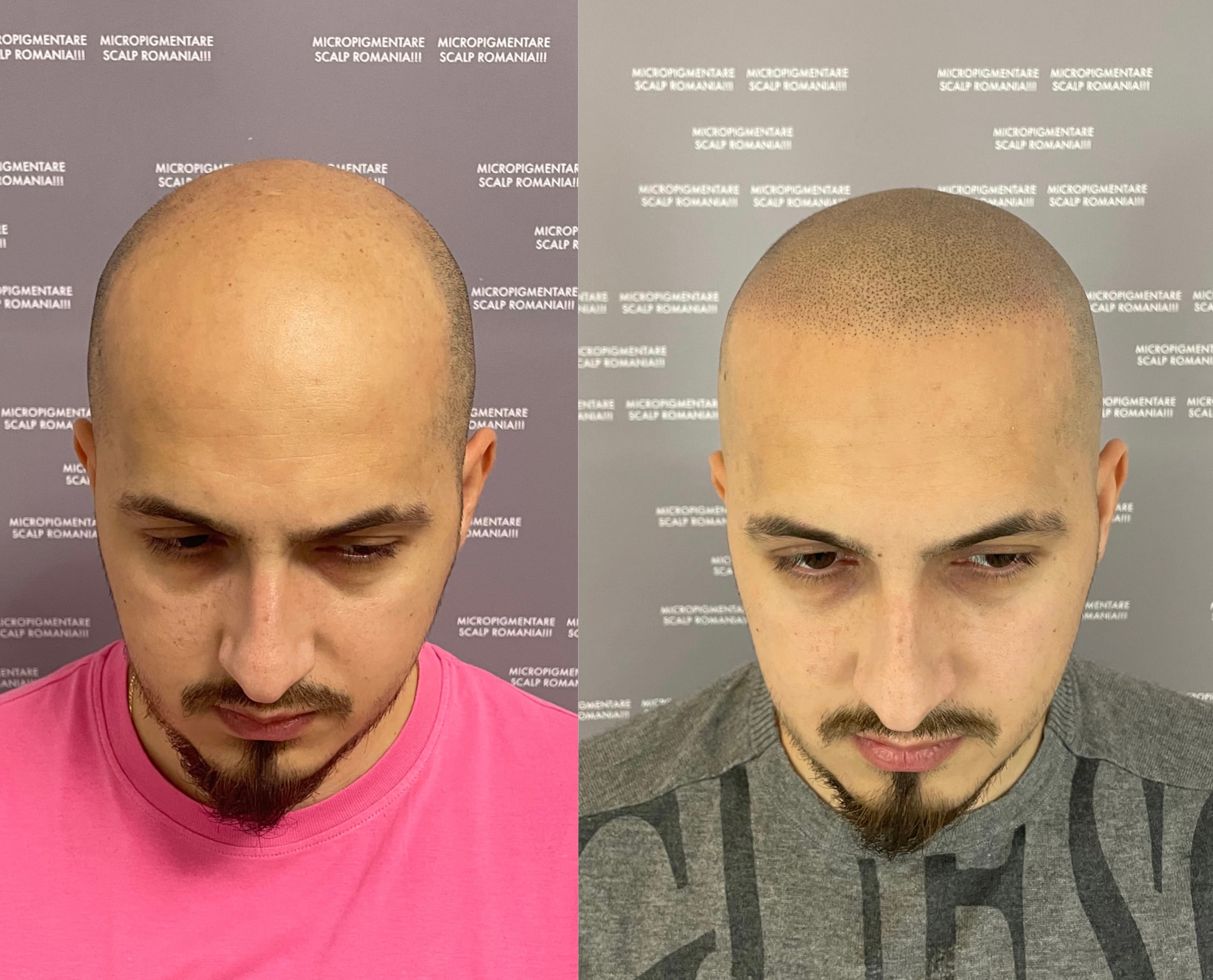 Perspectivă micropigmentare scalp - Alopecie Androgenetică