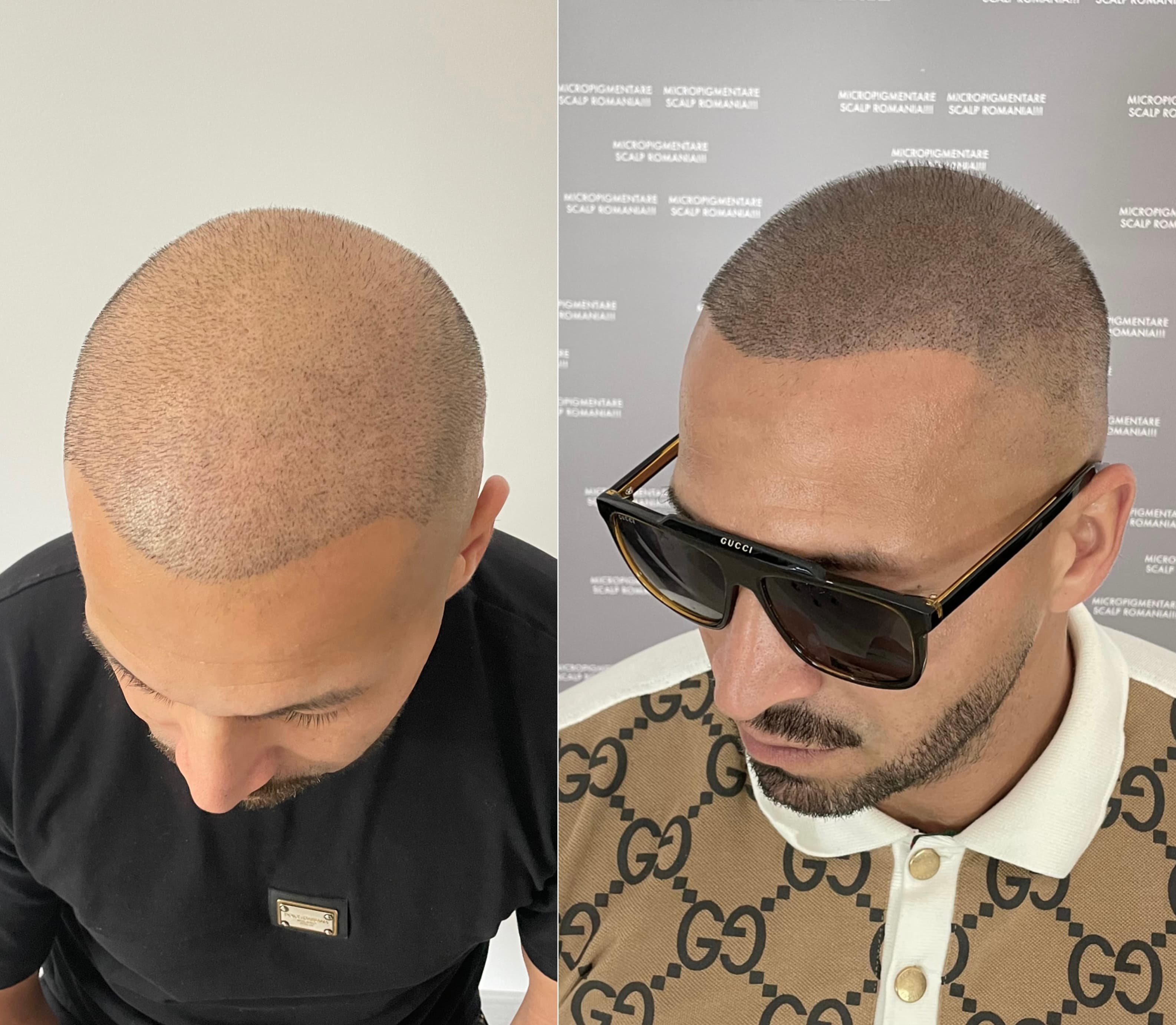 Perspectivă micropigmentare scalp - Densitate Post Transplant