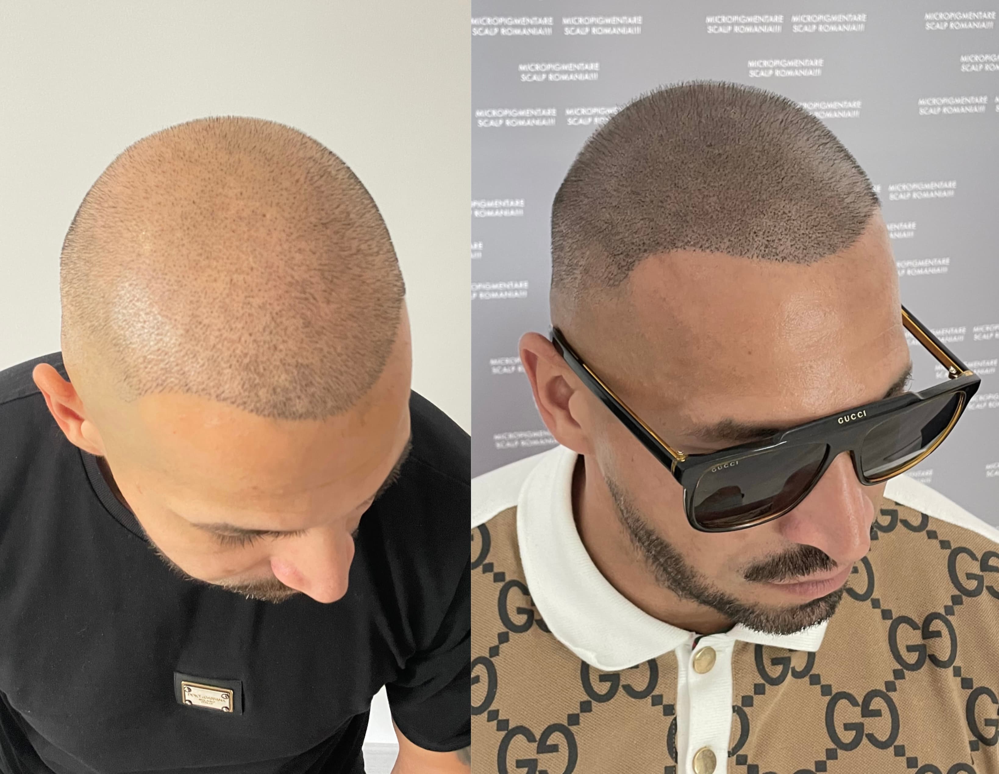 Perspectivă micropigmentare scalp - Densitate Post Transplant