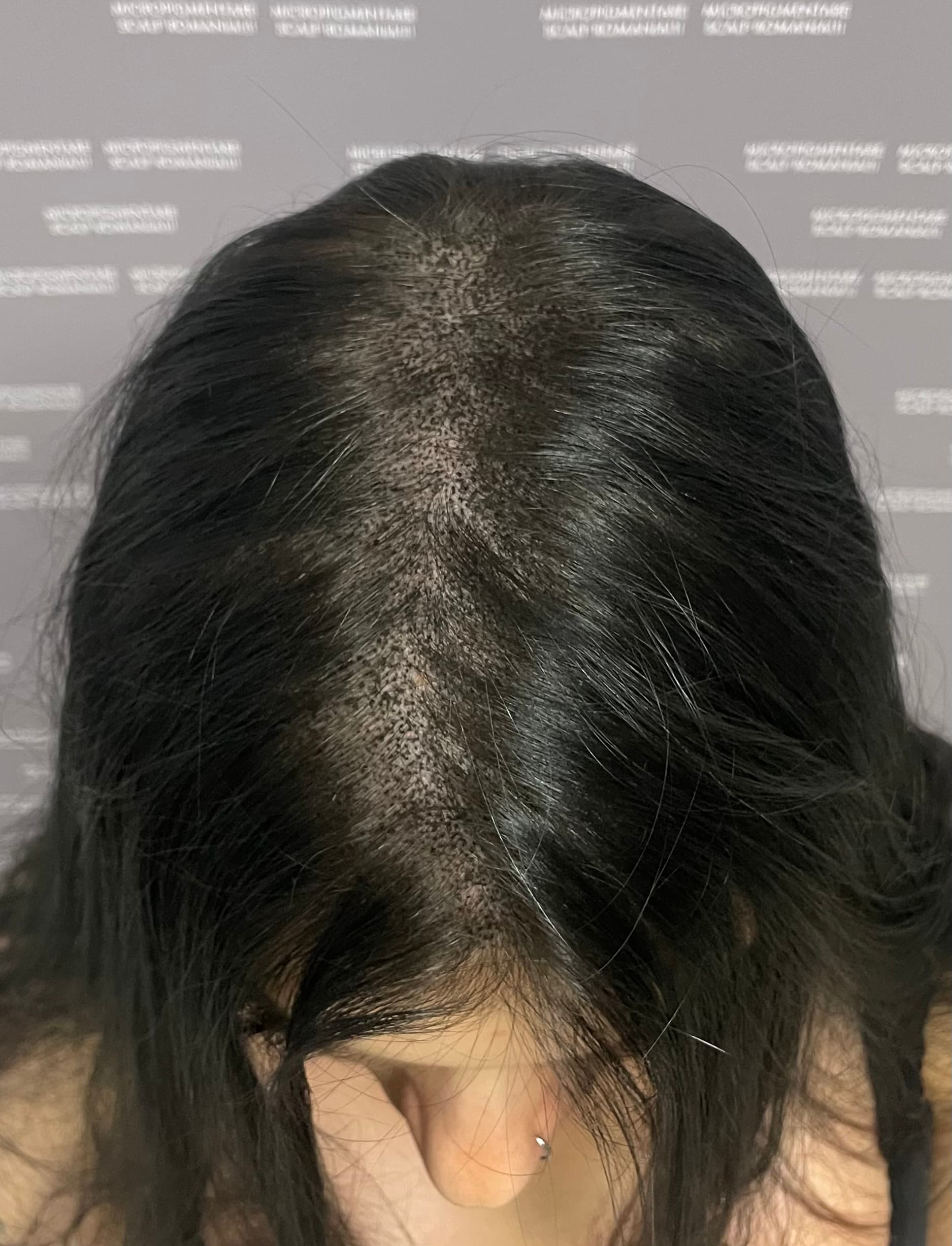 După micropigmentare scalp - Micropigmentare Scalp Femei